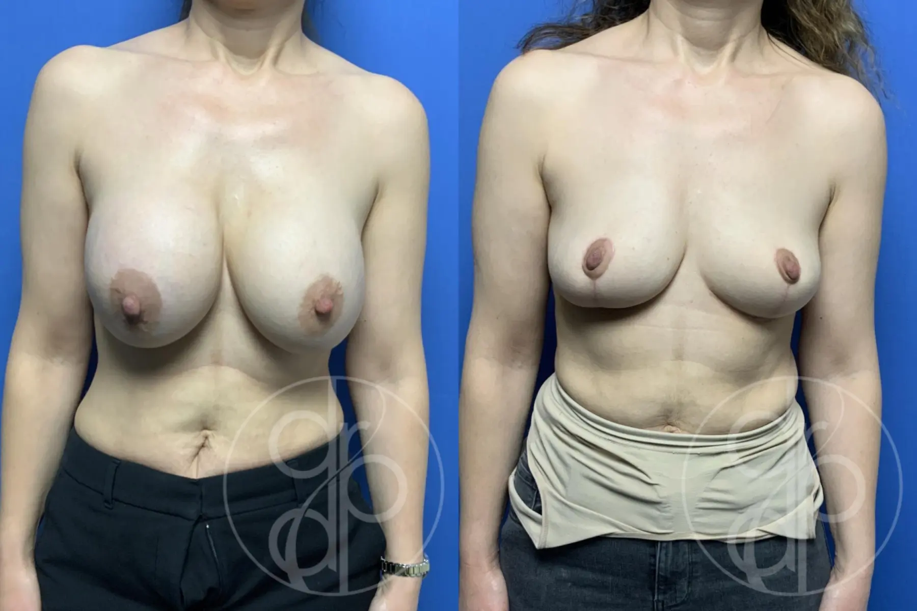 patient 13794 breast implant removal with lift before and after result - Before and After