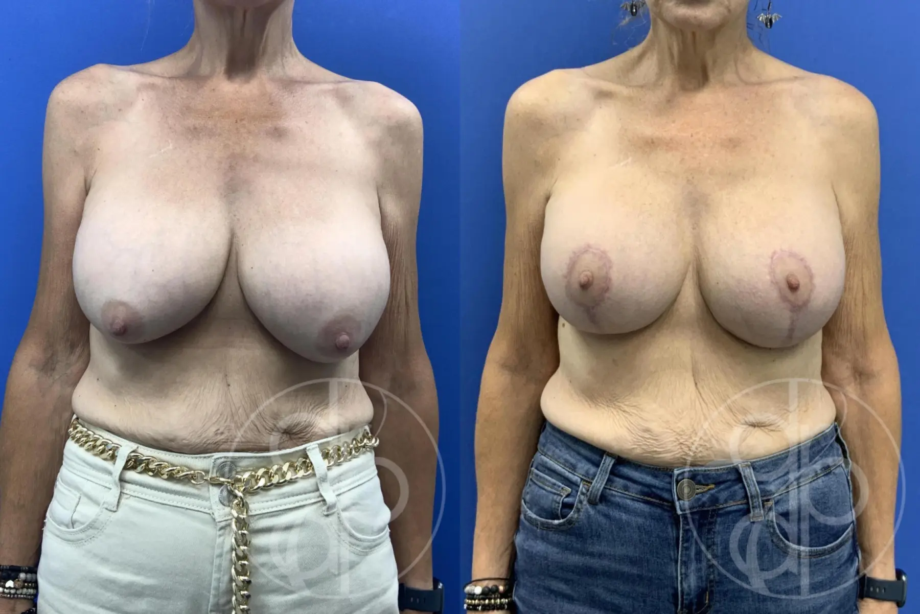 patient 12785 breast implant revised before and after result - Before and After