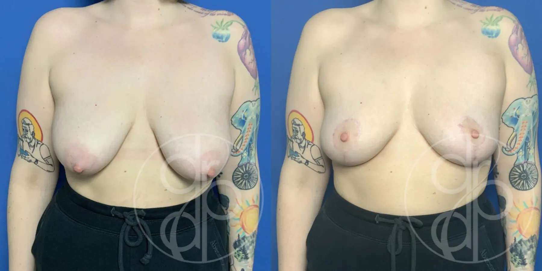 patient 12704 breast lift before and after result - Before and After