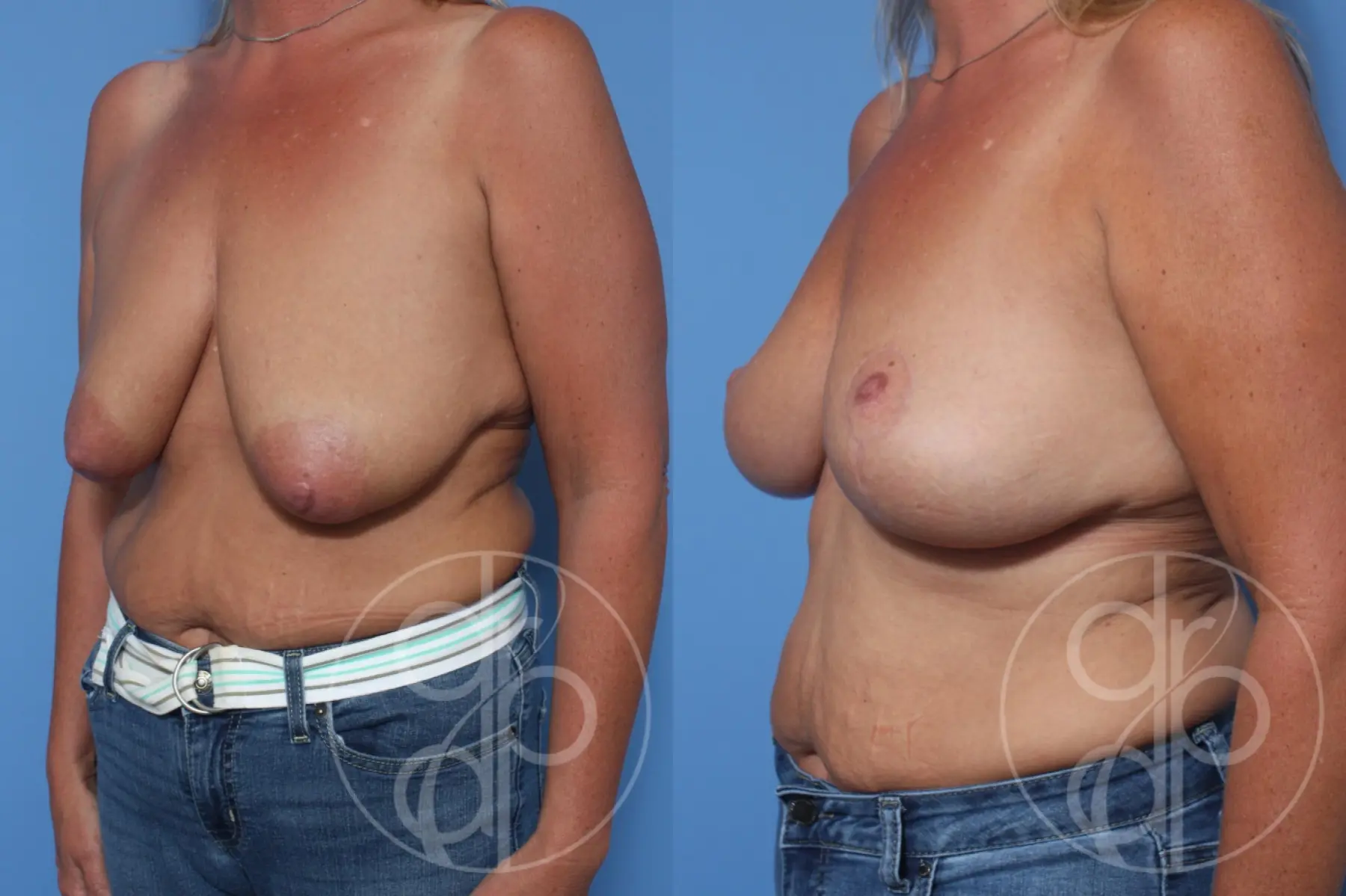 patient 13039 breast lift before and after result - Before and After 3