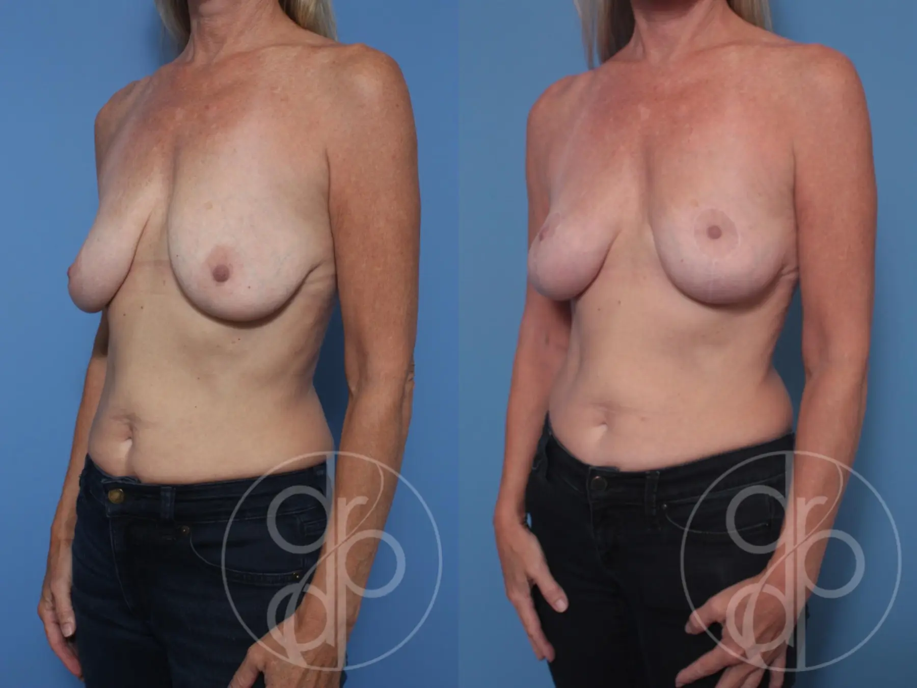 patient 10129 breast lift before and after result - Before and After 2