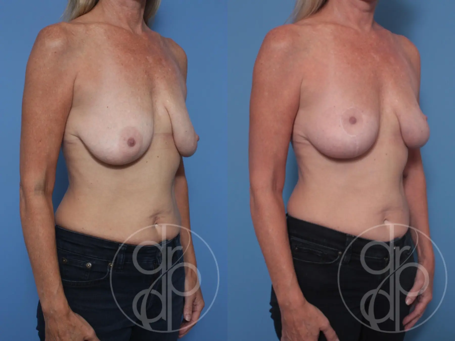 patient 10129 breast lift before and after result - Before and After 3