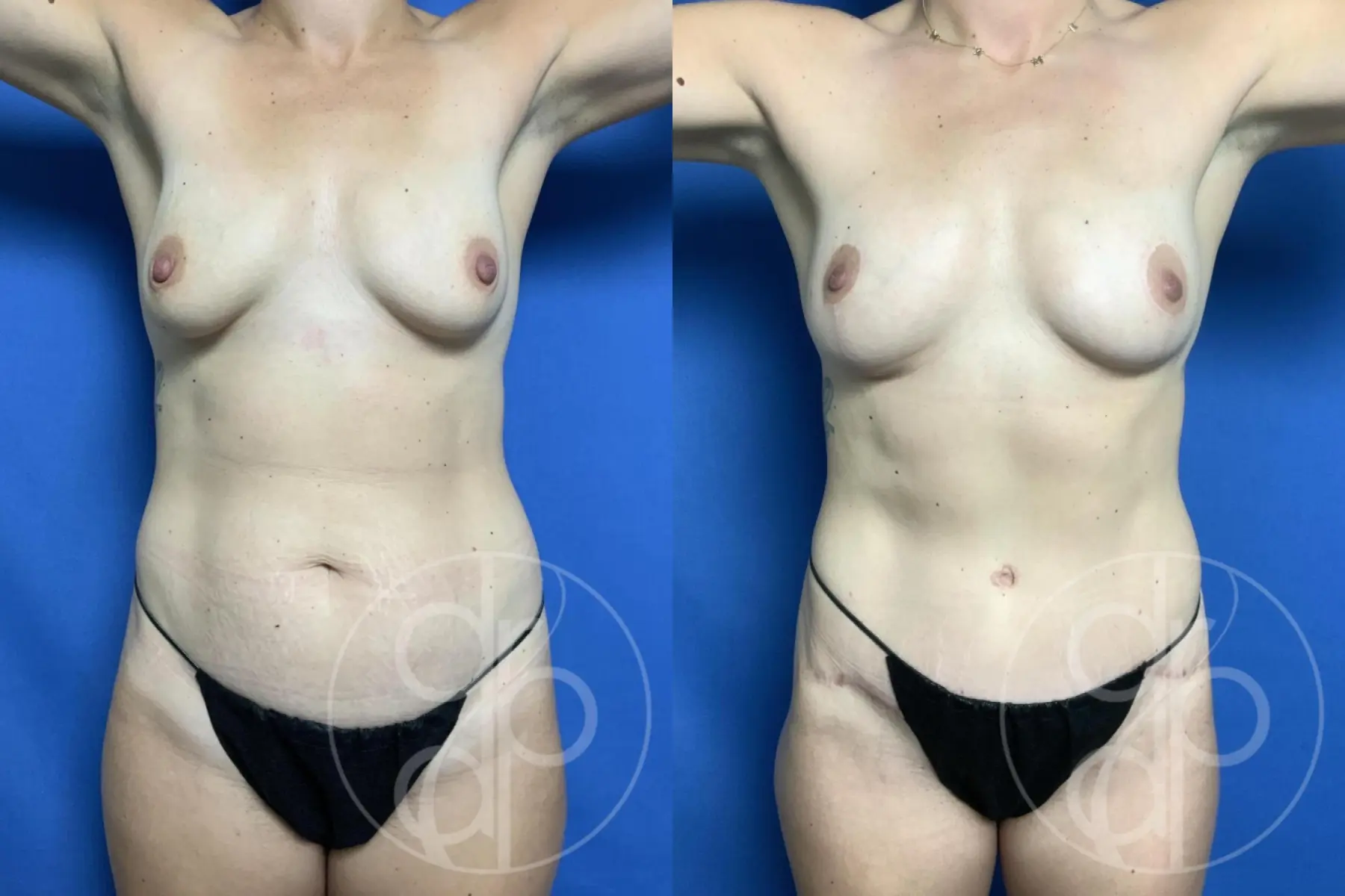 patient 12276 mommy makeover before and after result - Before and After 2