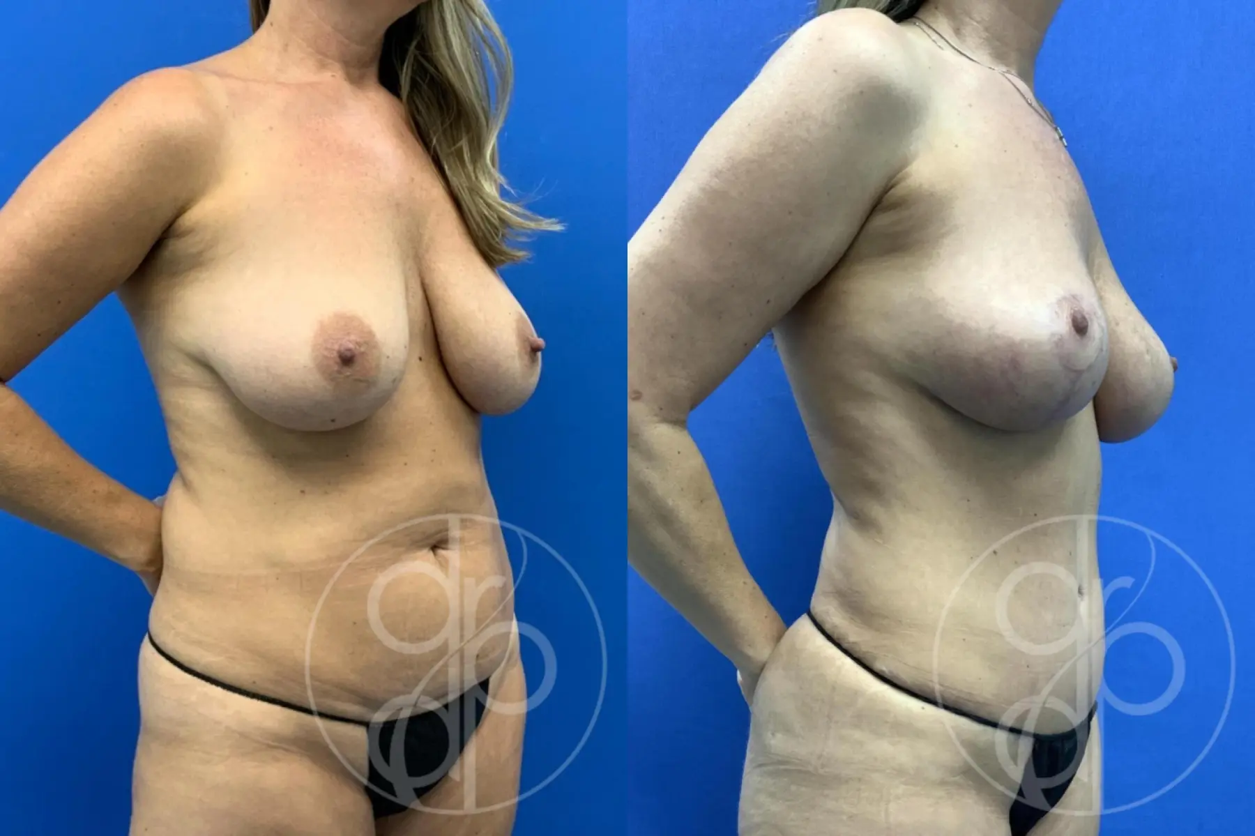patient 14798 mommy makeover before and after result - Before and After 4