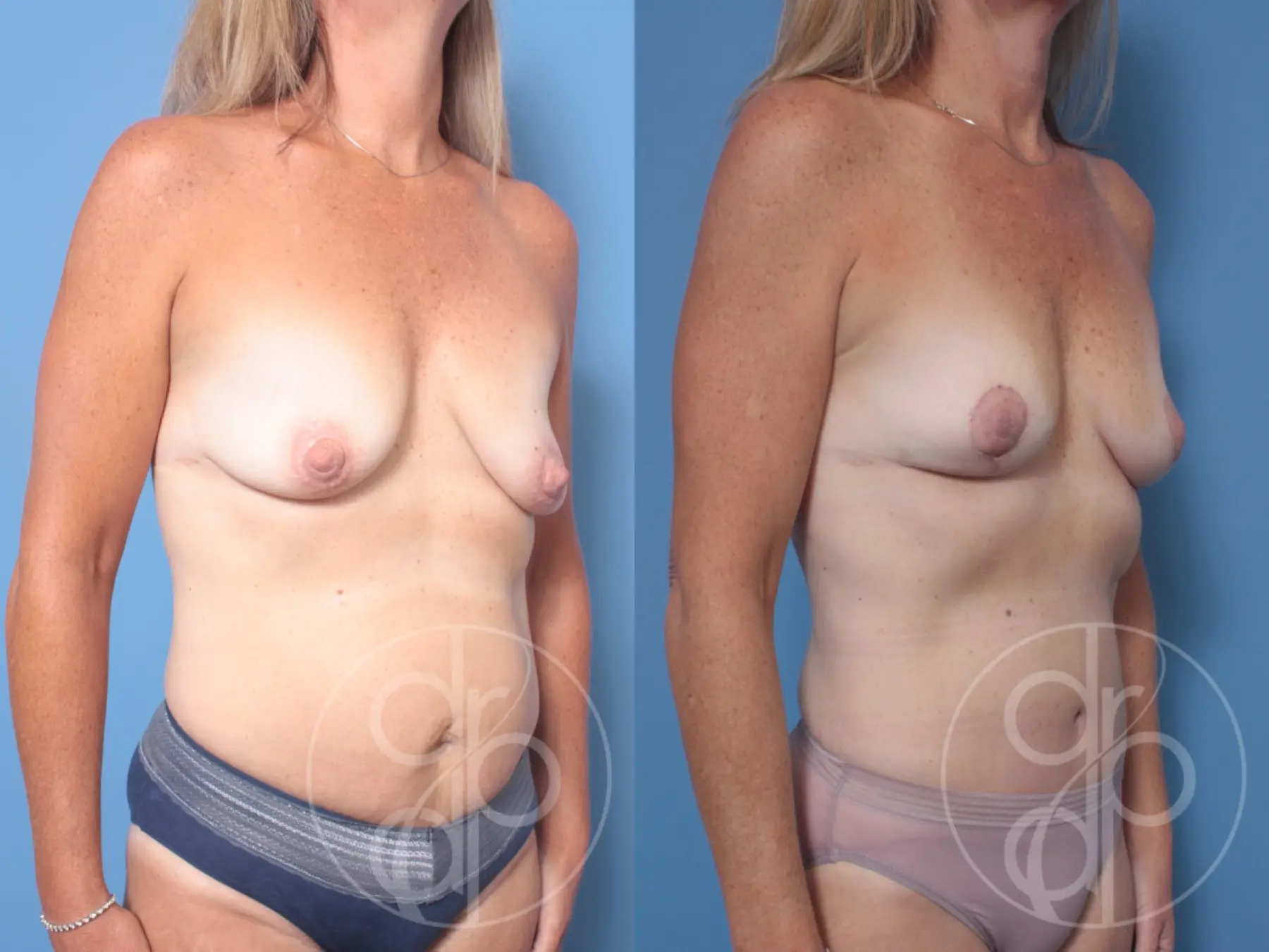 patient 10149 mommy makeover before and after result - Before and After 2