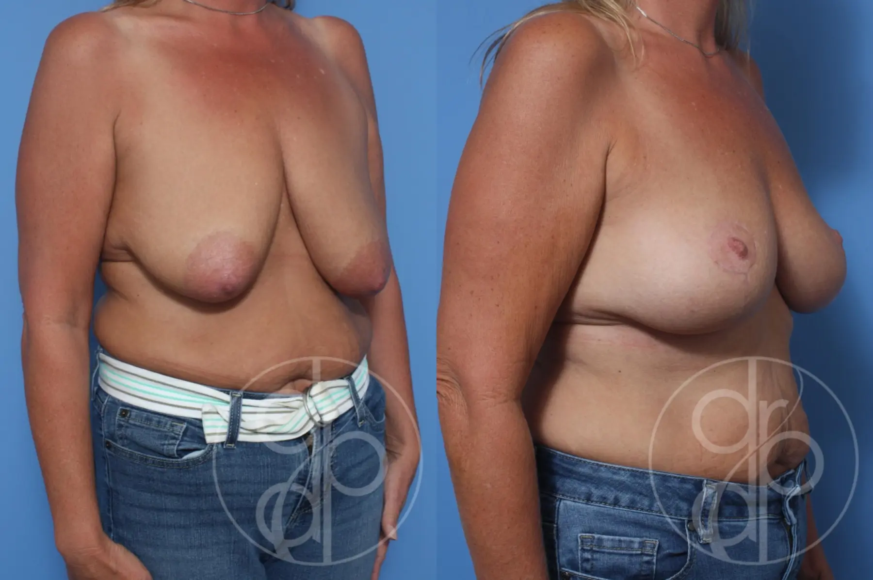 patient 13039 breast lift before and after result - Before and After 2