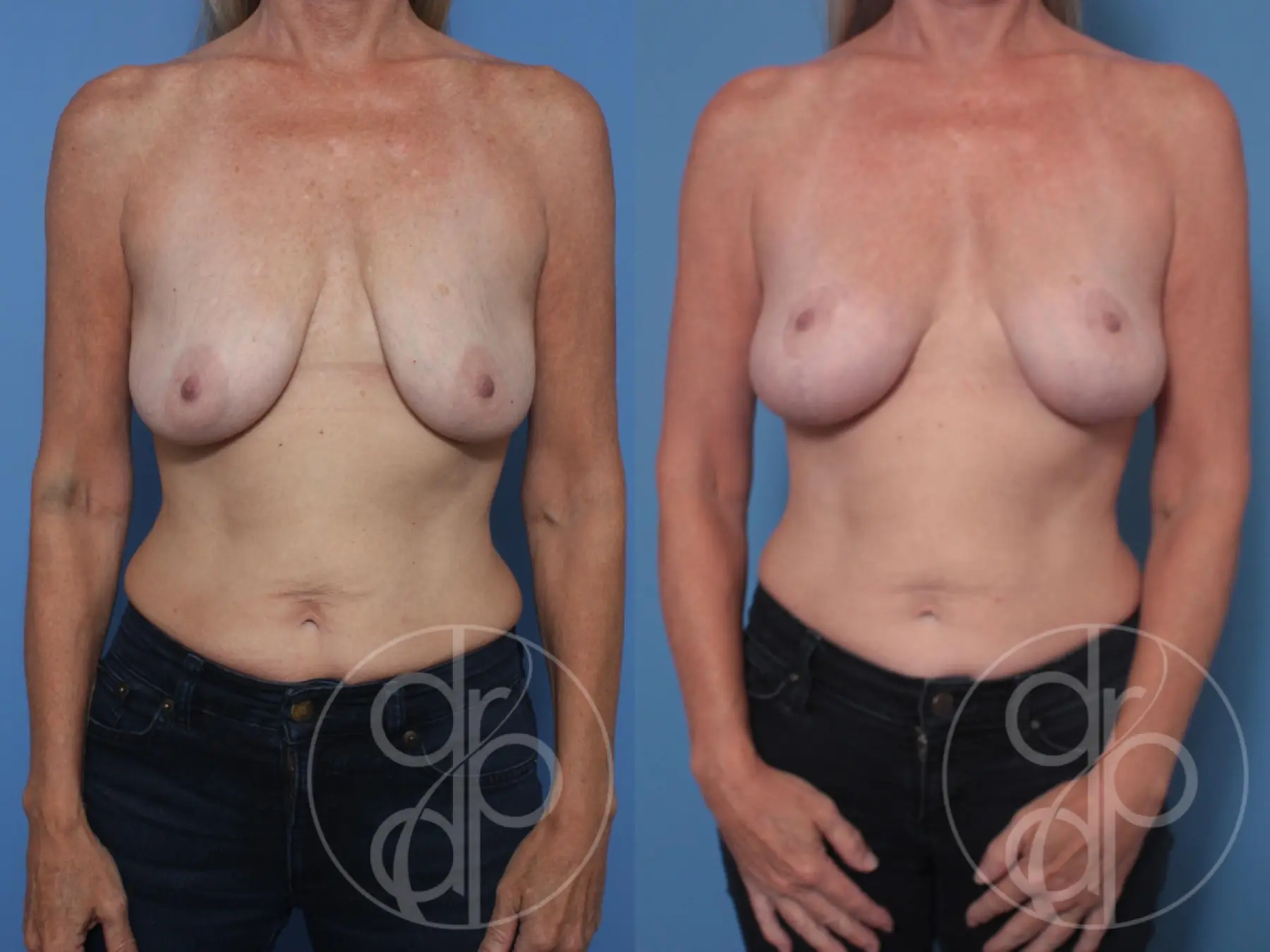 patient 10129 breast lift before and after result - Before and After 1