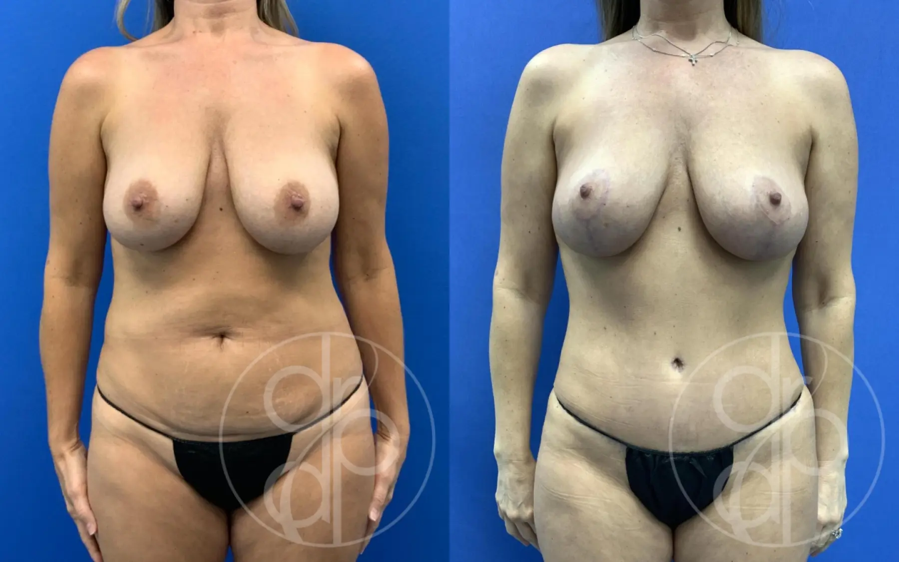 patient 14798 mommy makeover before and after result - Before and After