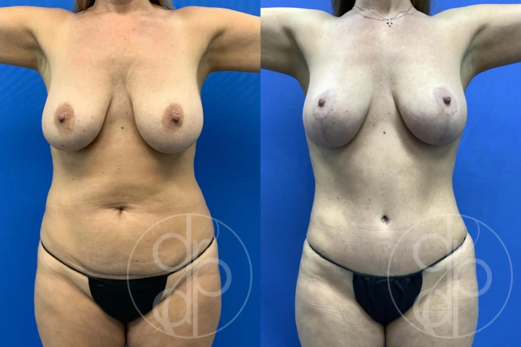 patient 14798 mommy makeover before and after result - Before and After 2