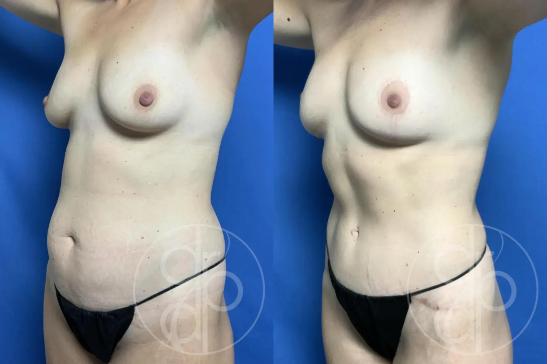 patient 12276 mommy makeover before and after result - Before and After 4