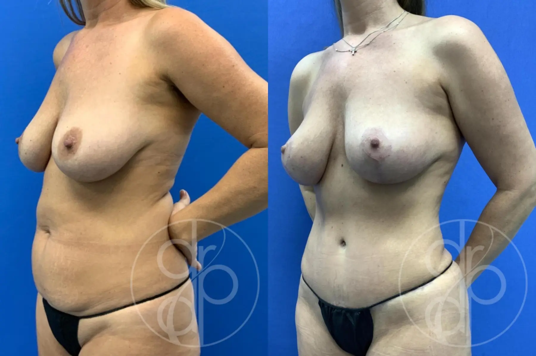 patient 14798 mommy makeover before and after result - Before and After 3
