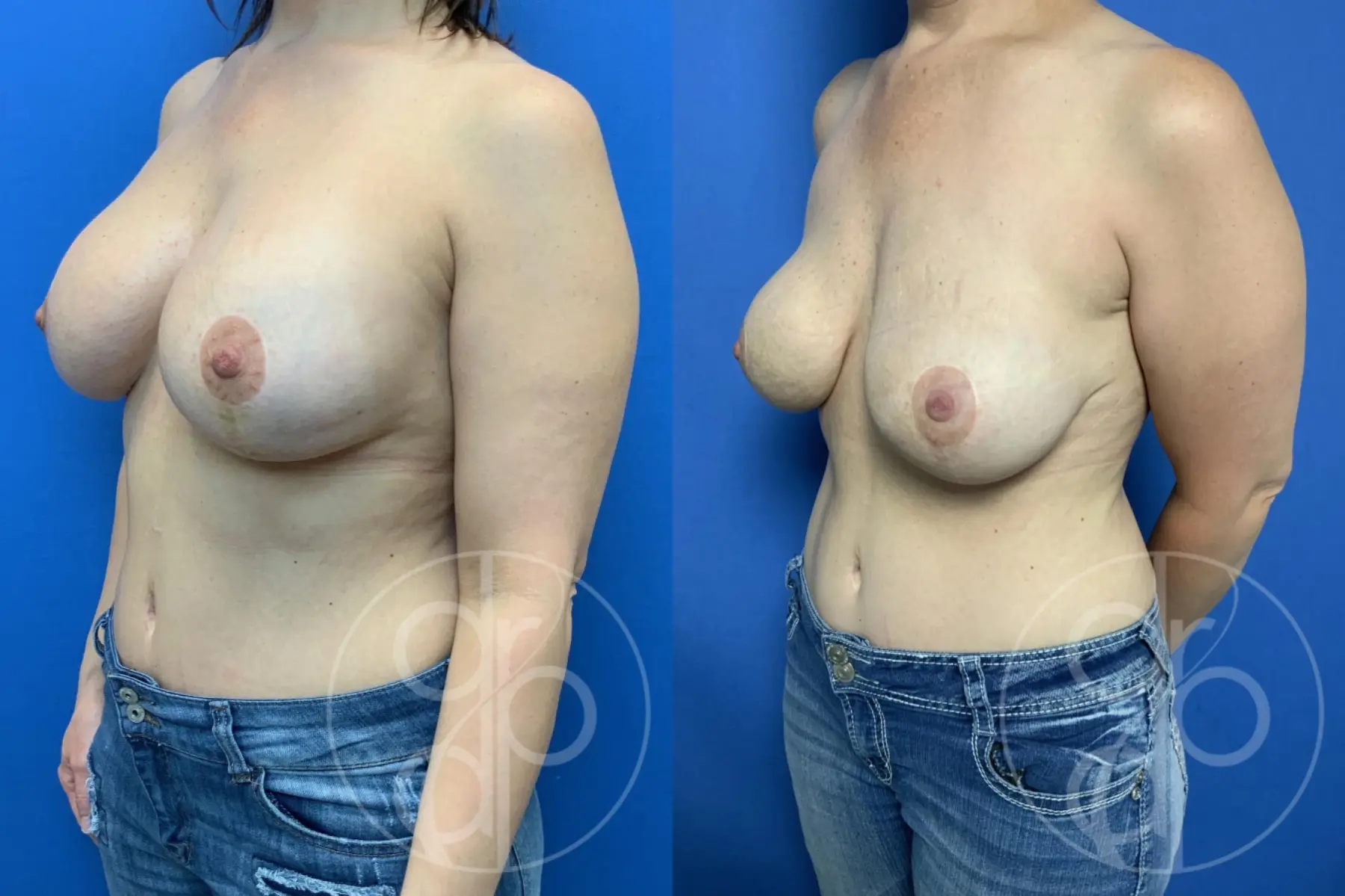 patient 10791 breast reconstruction before and after result - Before and After 3