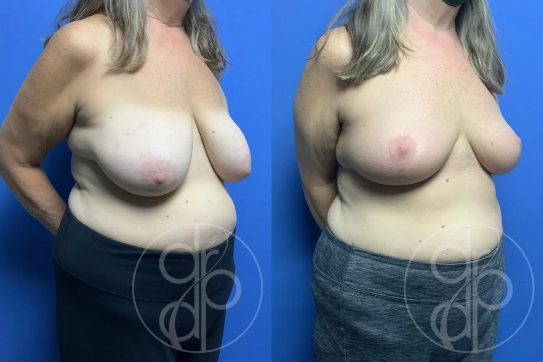 patient 12350 breast reconstruction before and after result - Before and After 2