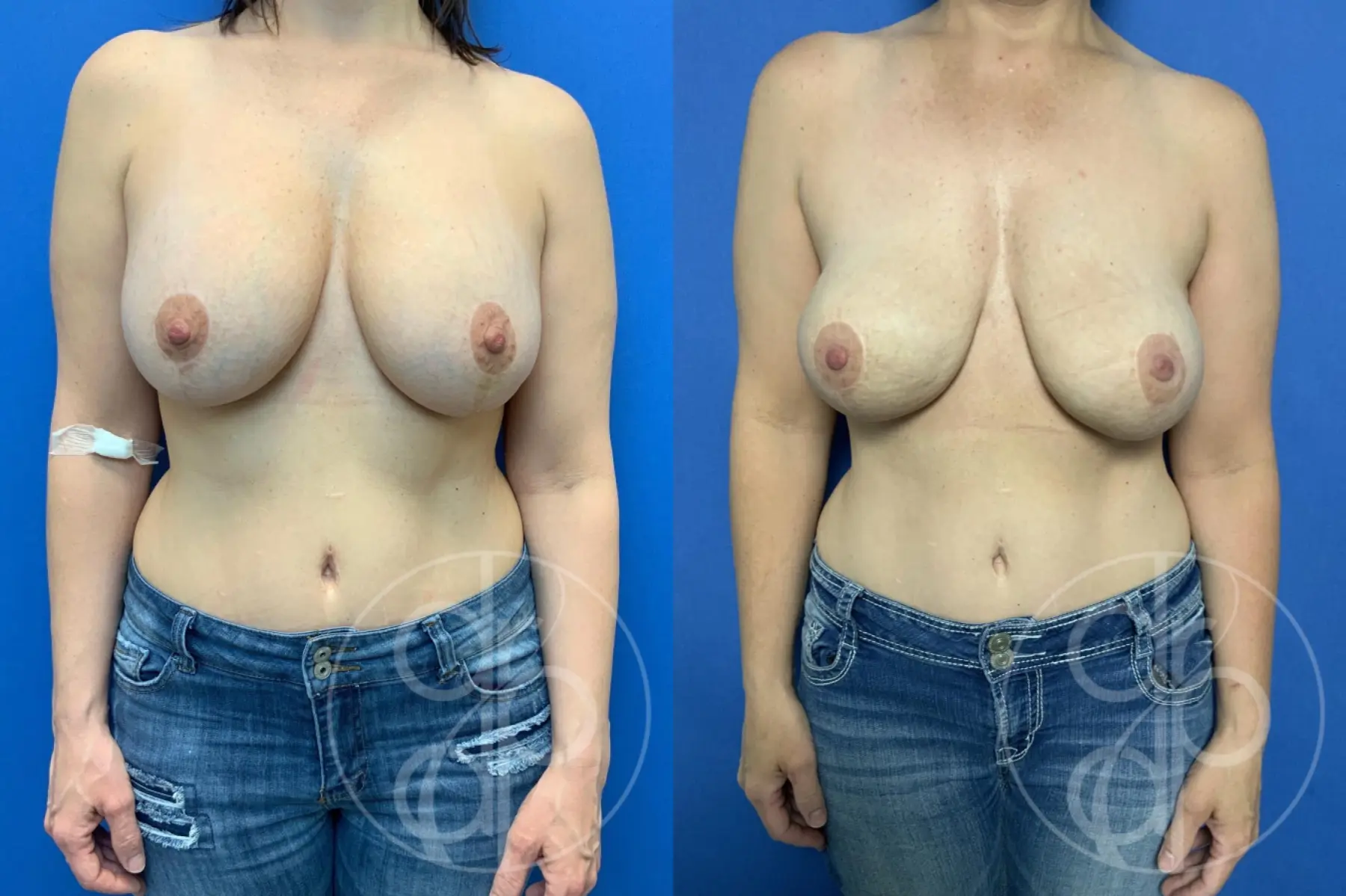 patient 10791 breast reconstruction before and after result - Before and After