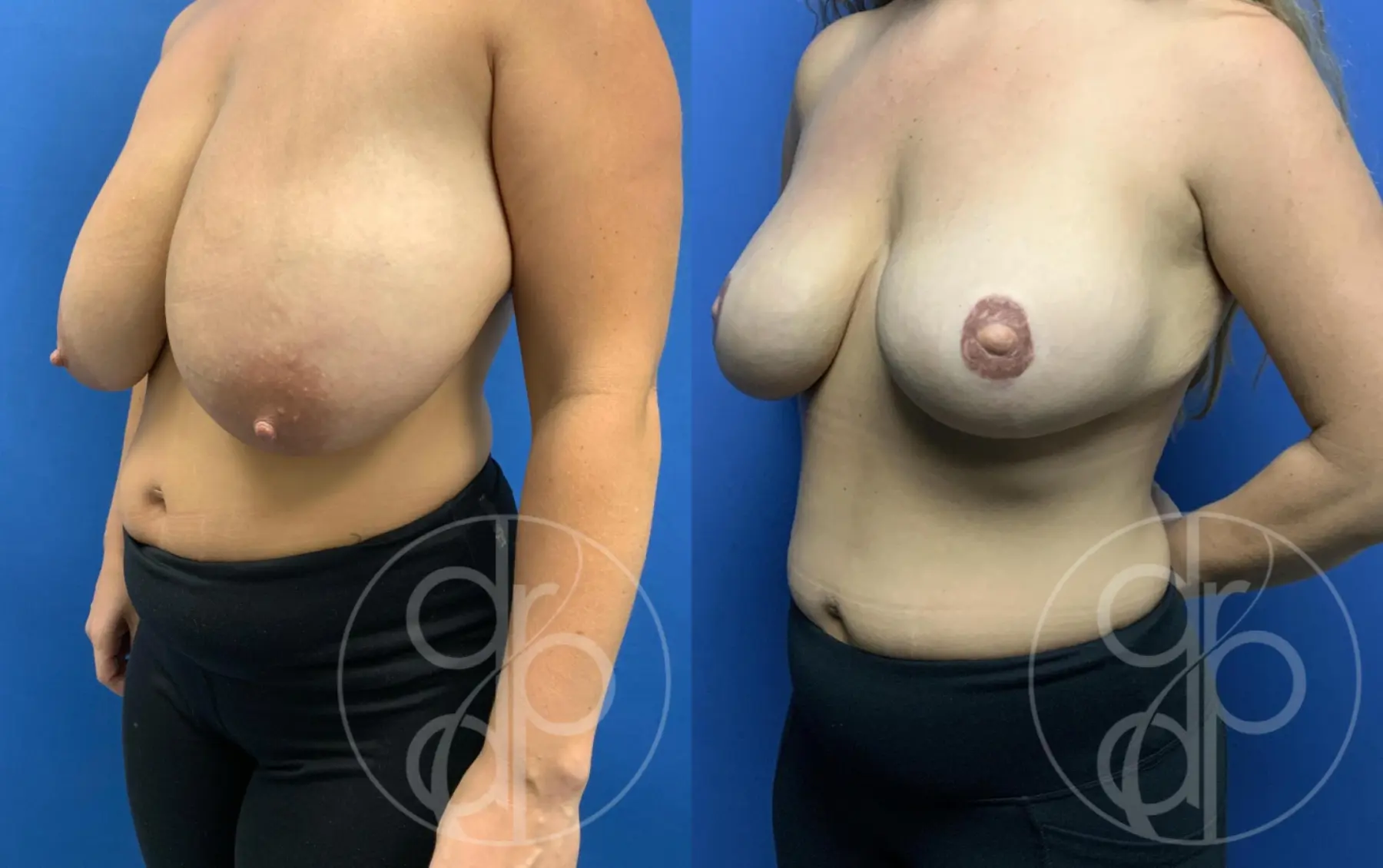 Breast Reconstruction: Patient 1 - Before and After 3