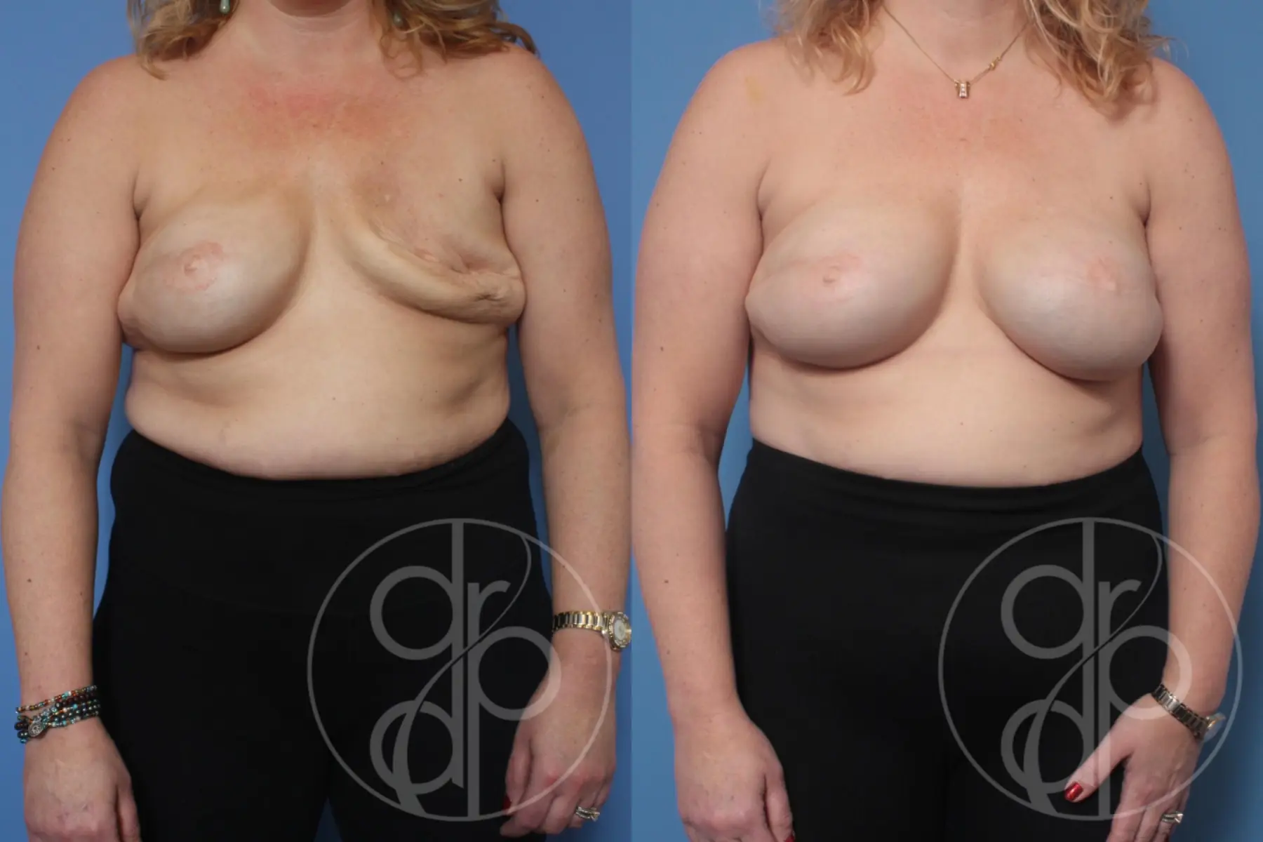 patient 10180 breast reconstruction before and after result - Before and After