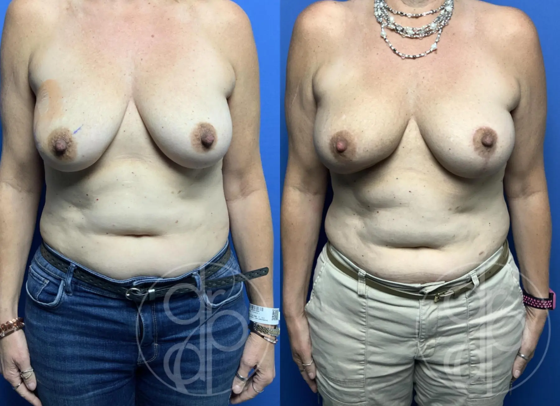 Breast Reconstruction: Patient 2 - Before and After 1