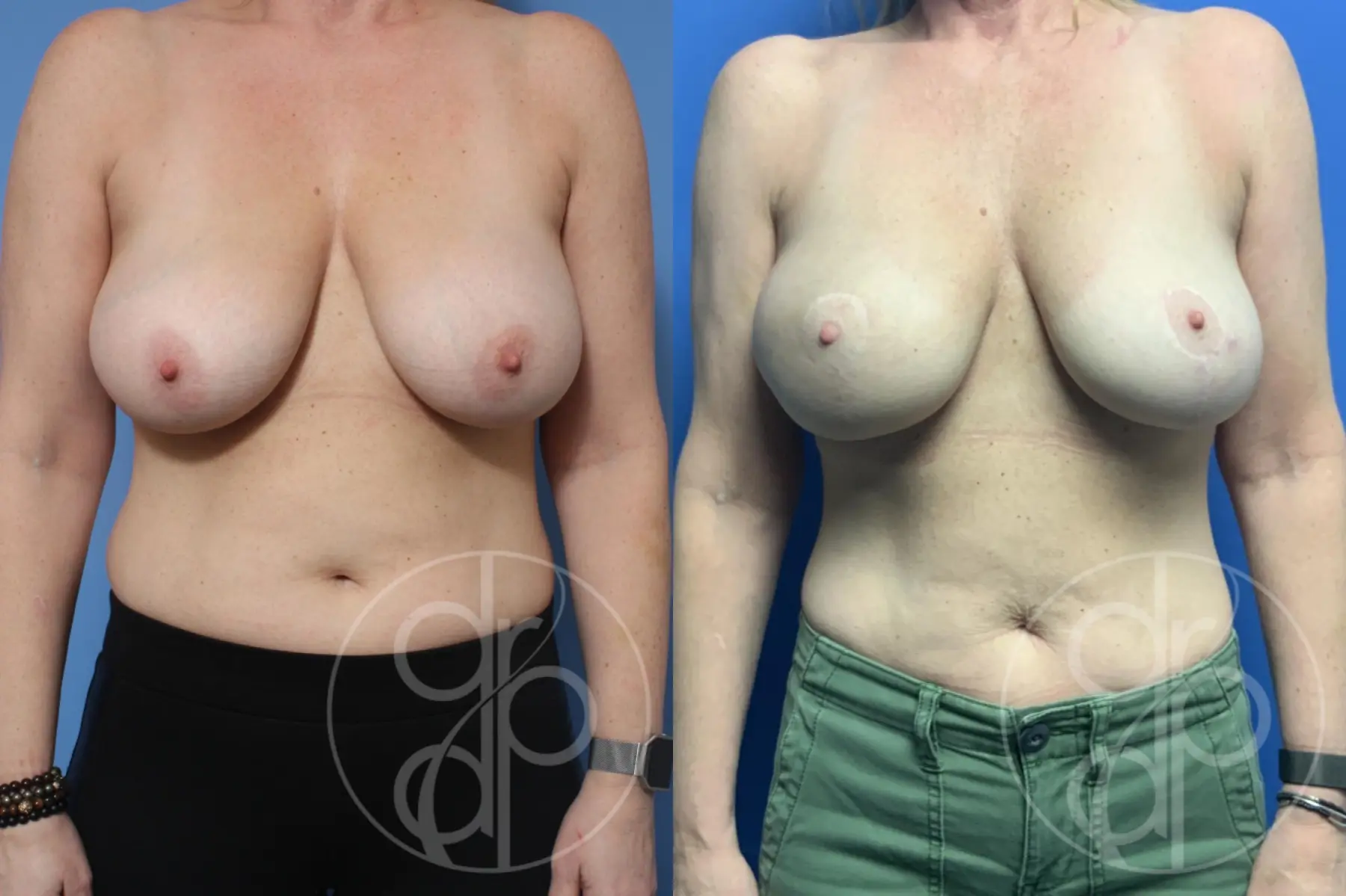 patient 10191 breast reconstruction before and after result - Before and After 1
