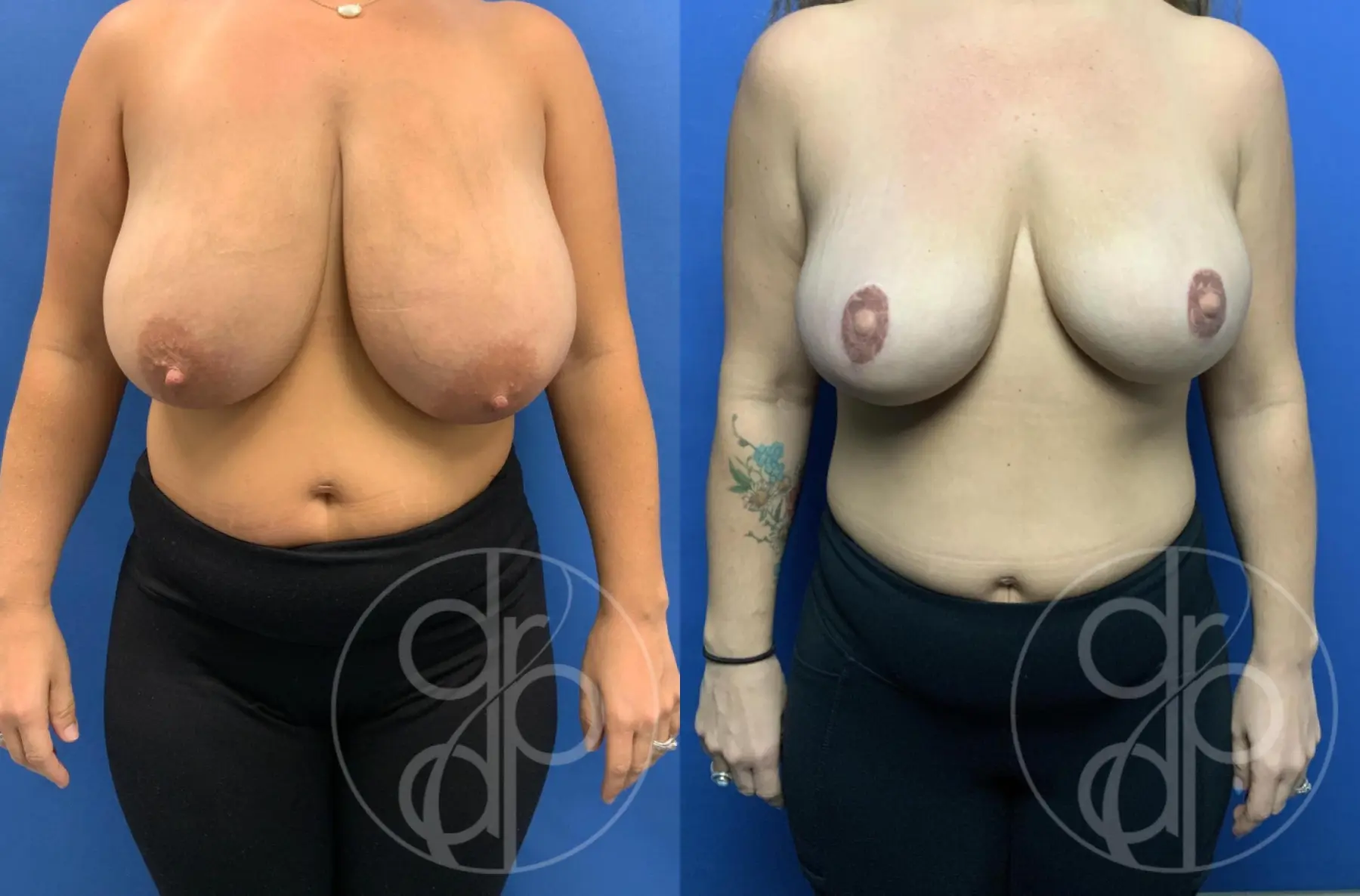 patient 10719 breast reconstruction before and after result - Before and After