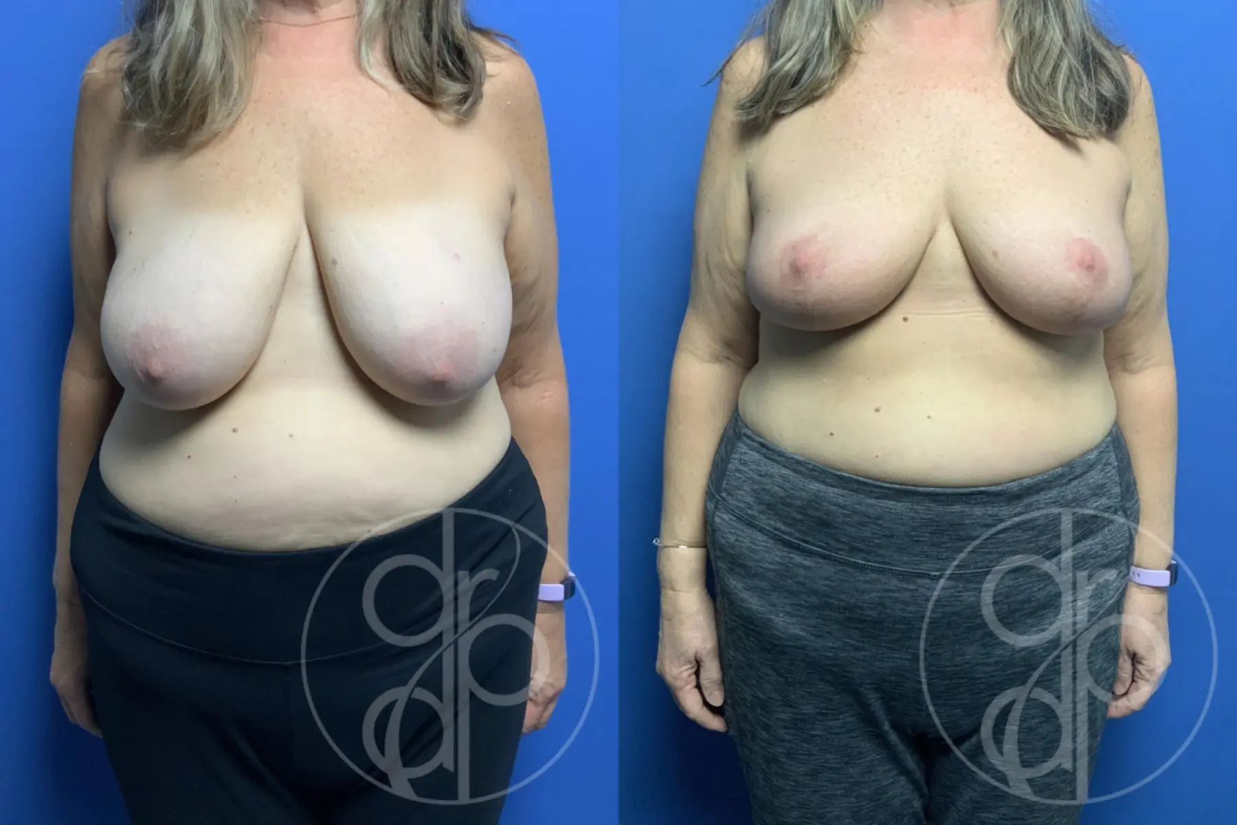 patient 12350 breast reconstruction before and after result - Before and After