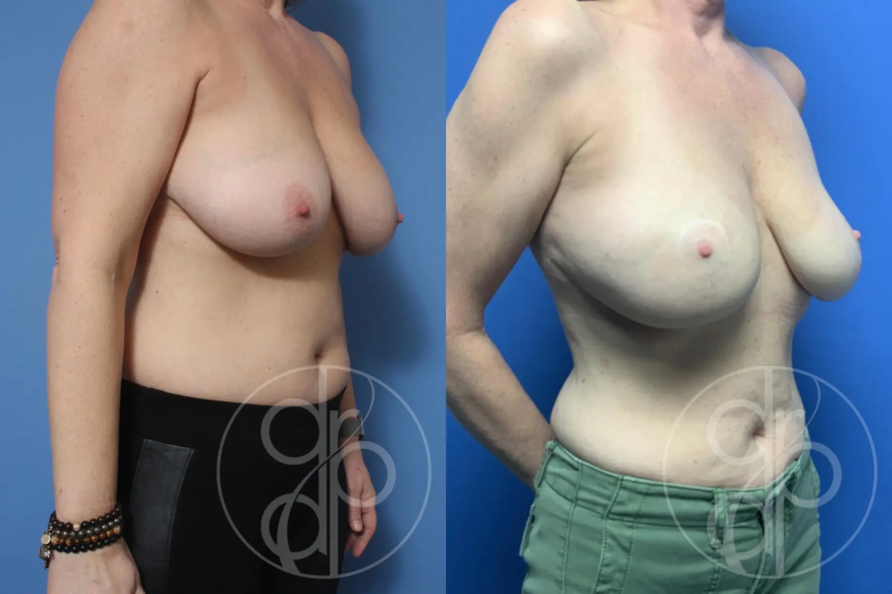 patient 10191 breast reconstruction before and after result - Before and After 2