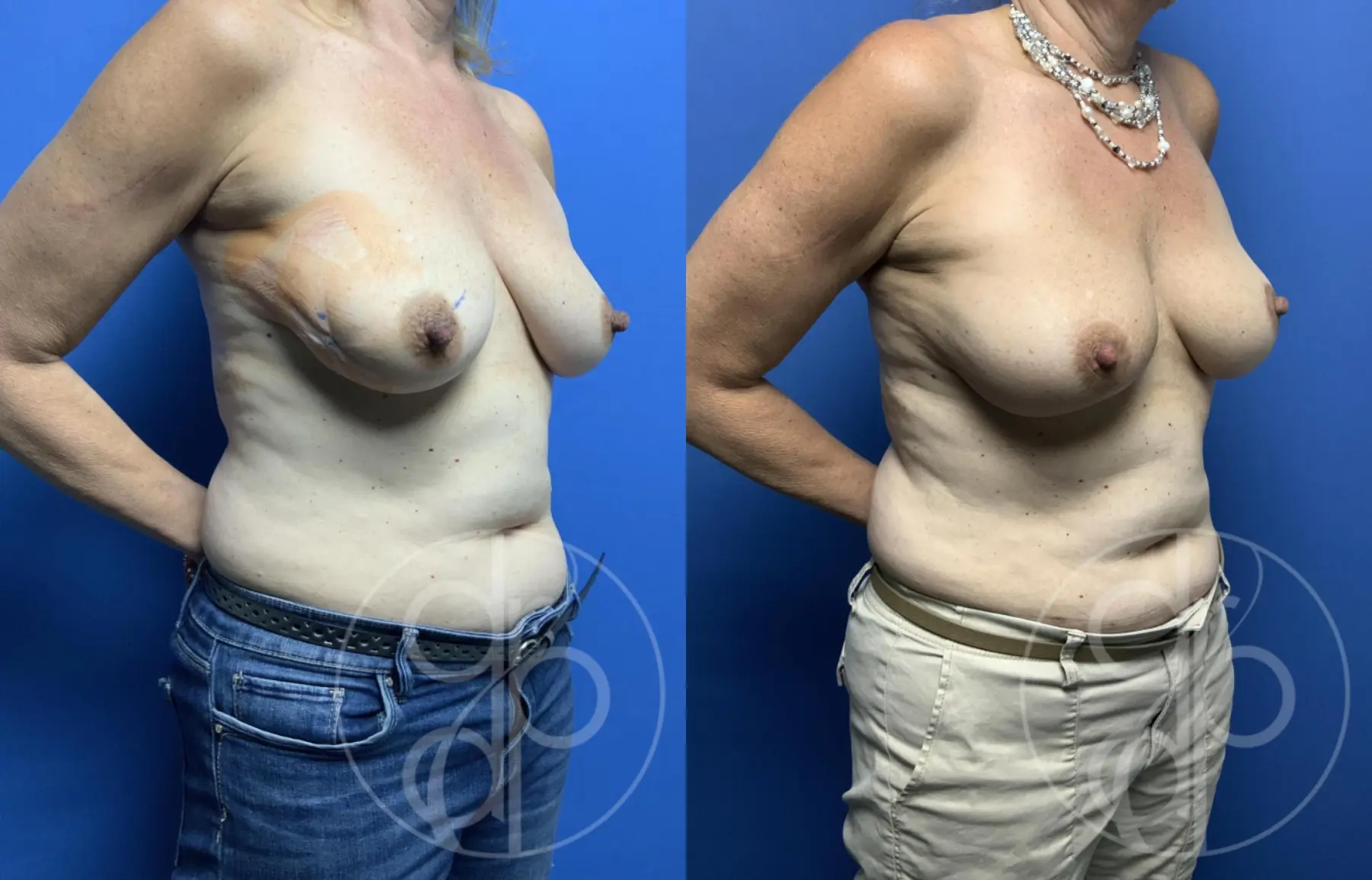 Breast Reconstruction: Patient 2 - Before and After 2