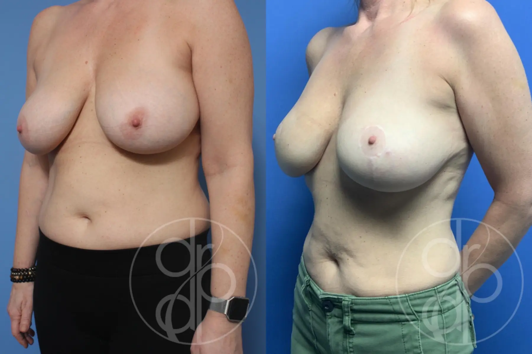 patient 10191 breast reconstruction before and after result - Before and After 3