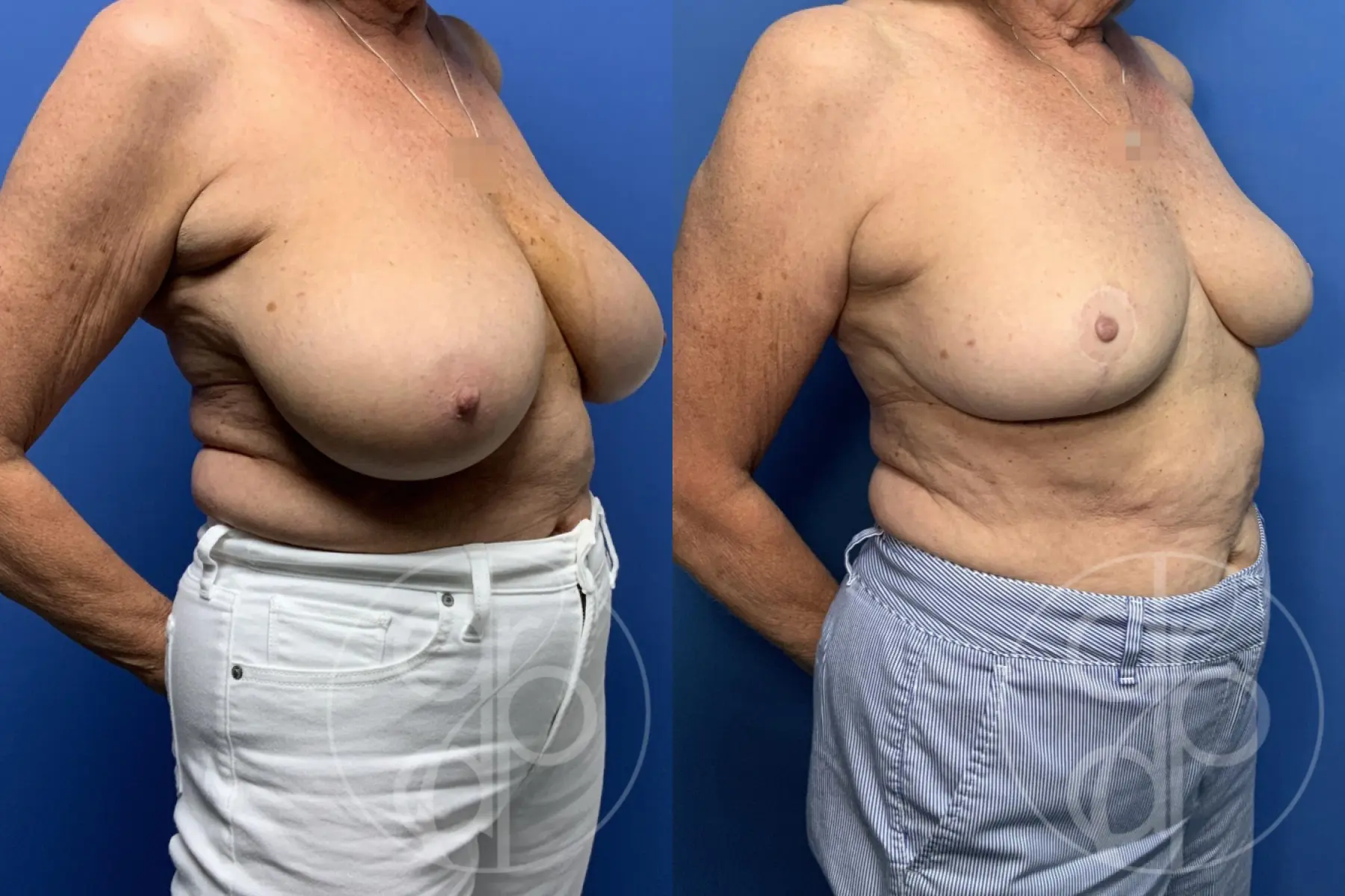 patient 13401 breast reduction before and after result - Before and After 2