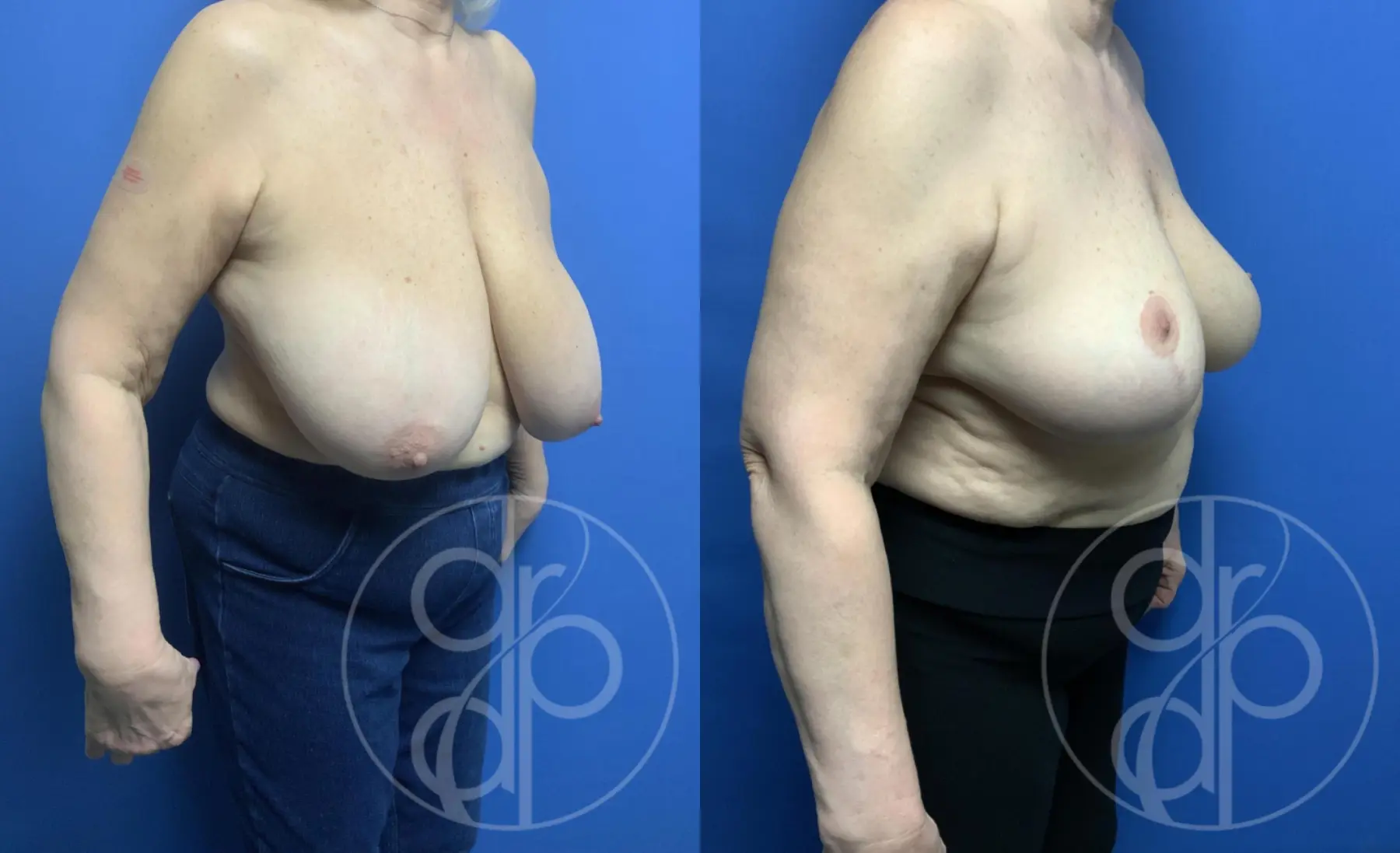 patient 12398 breast reduction before and after result - Before and After 2