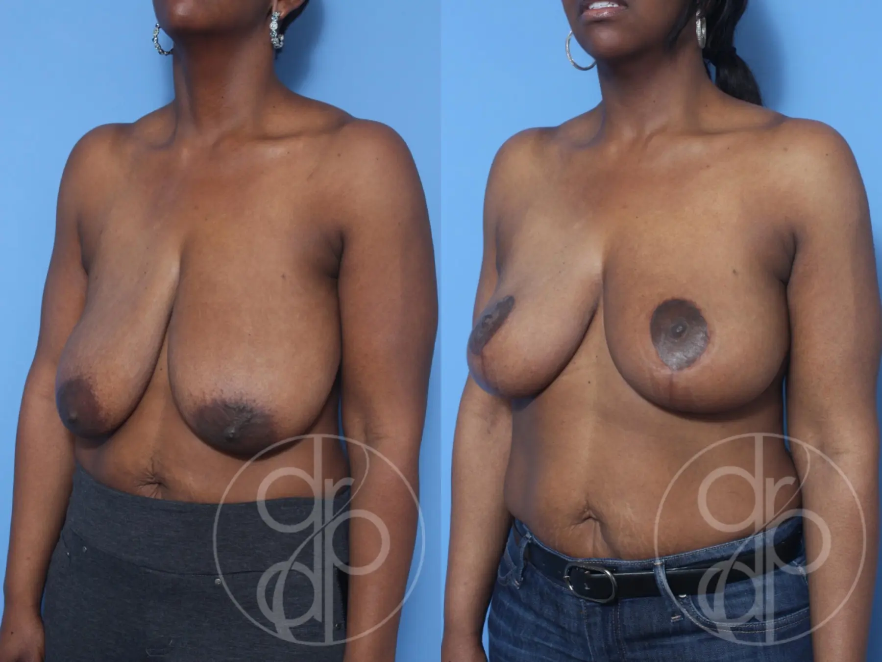 patient 13203 breast reduction before and after result - Before and After 3