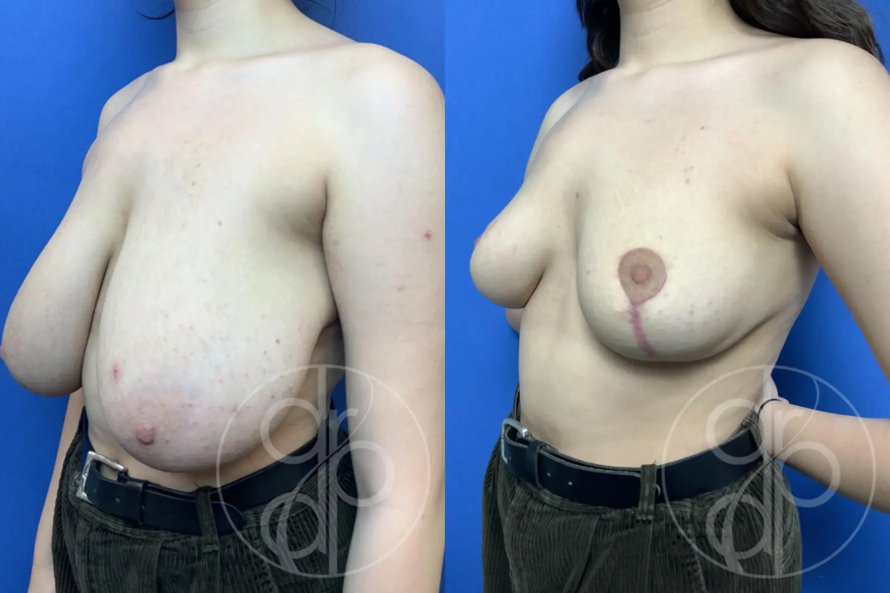 patient 11849 breast reduction before and after result - Before and After 2