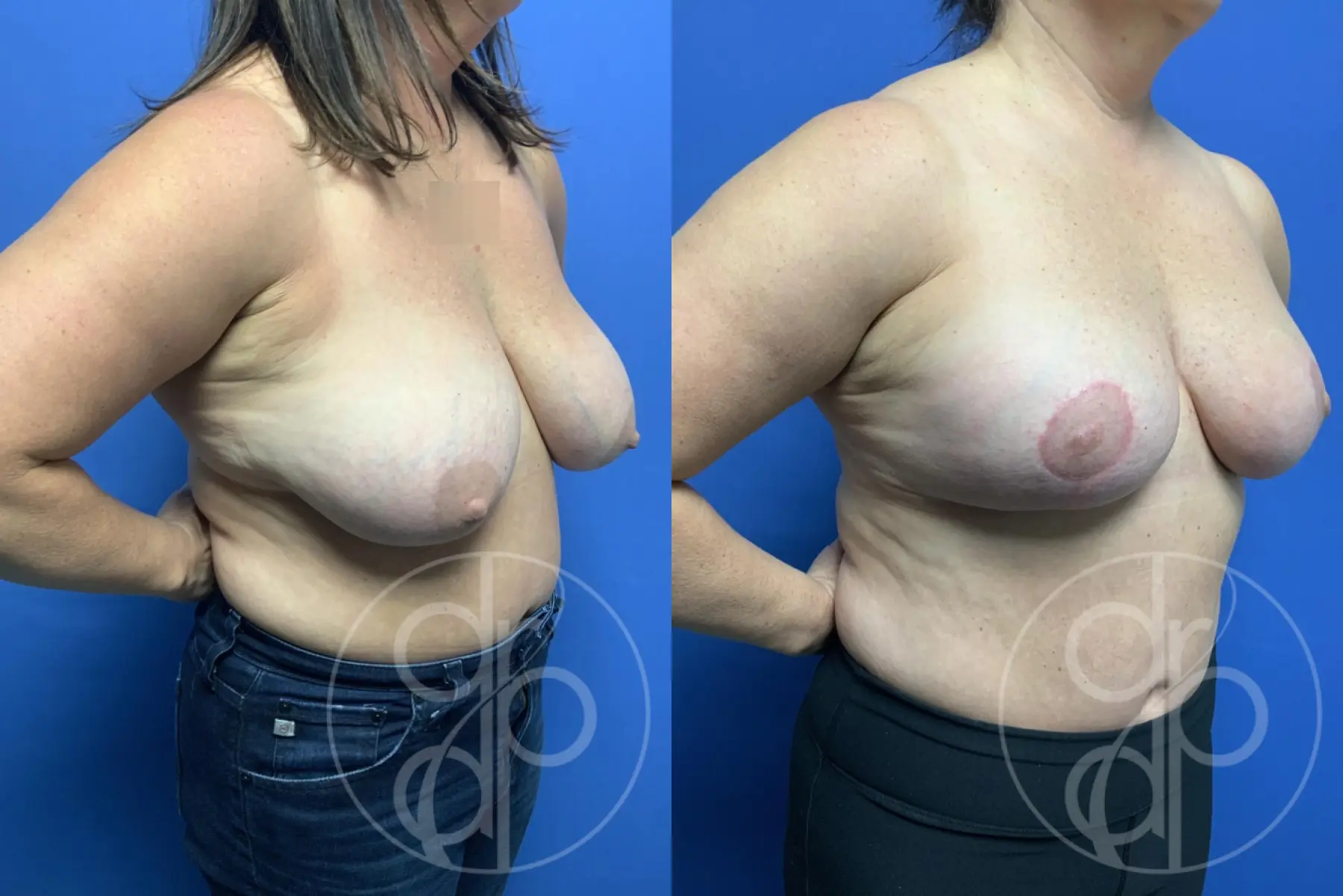 patient 13866 breast reduction before and after result - Before and After 2