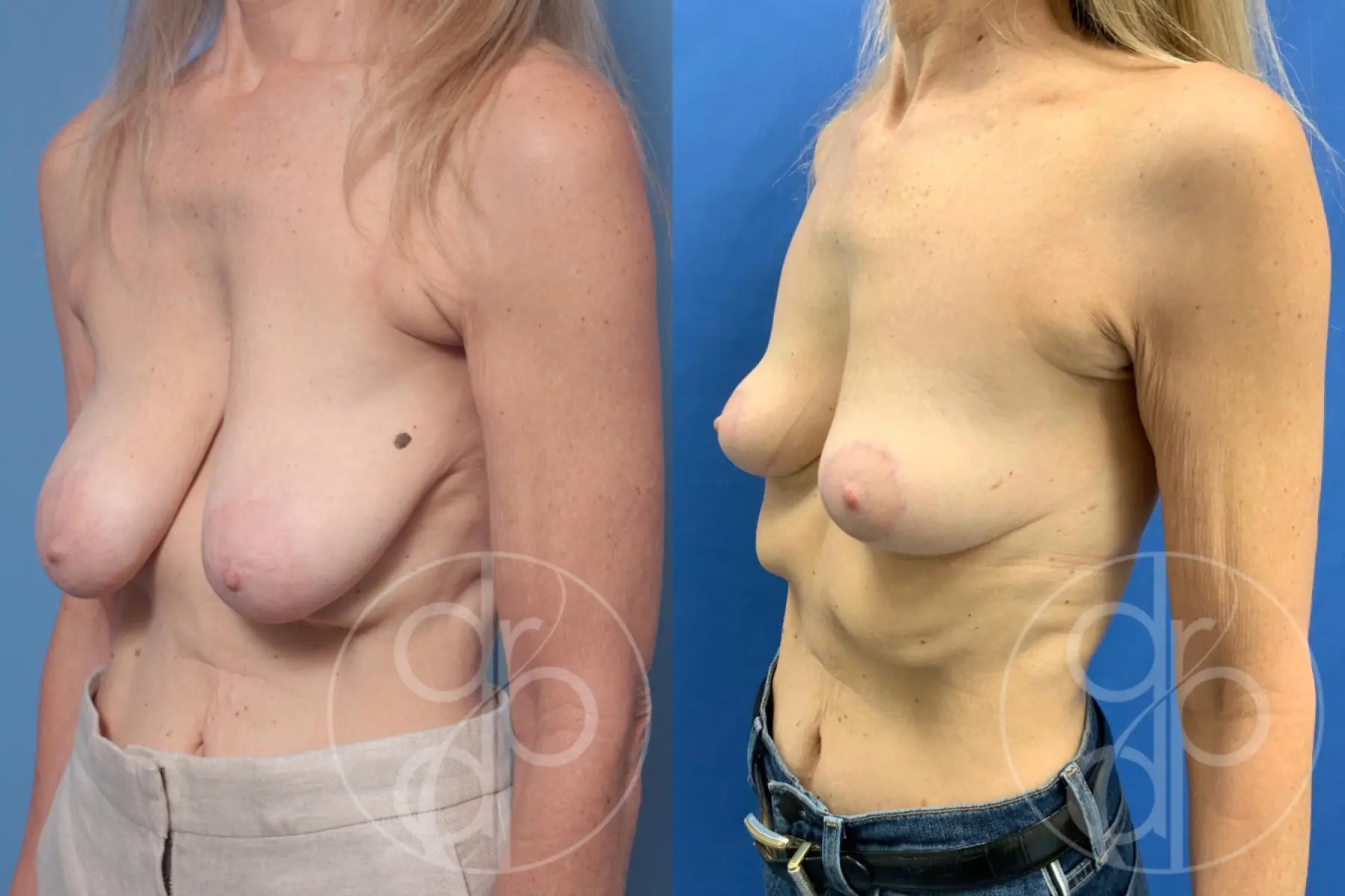 patient 10593 breast reduction before and after result - Before and After 2