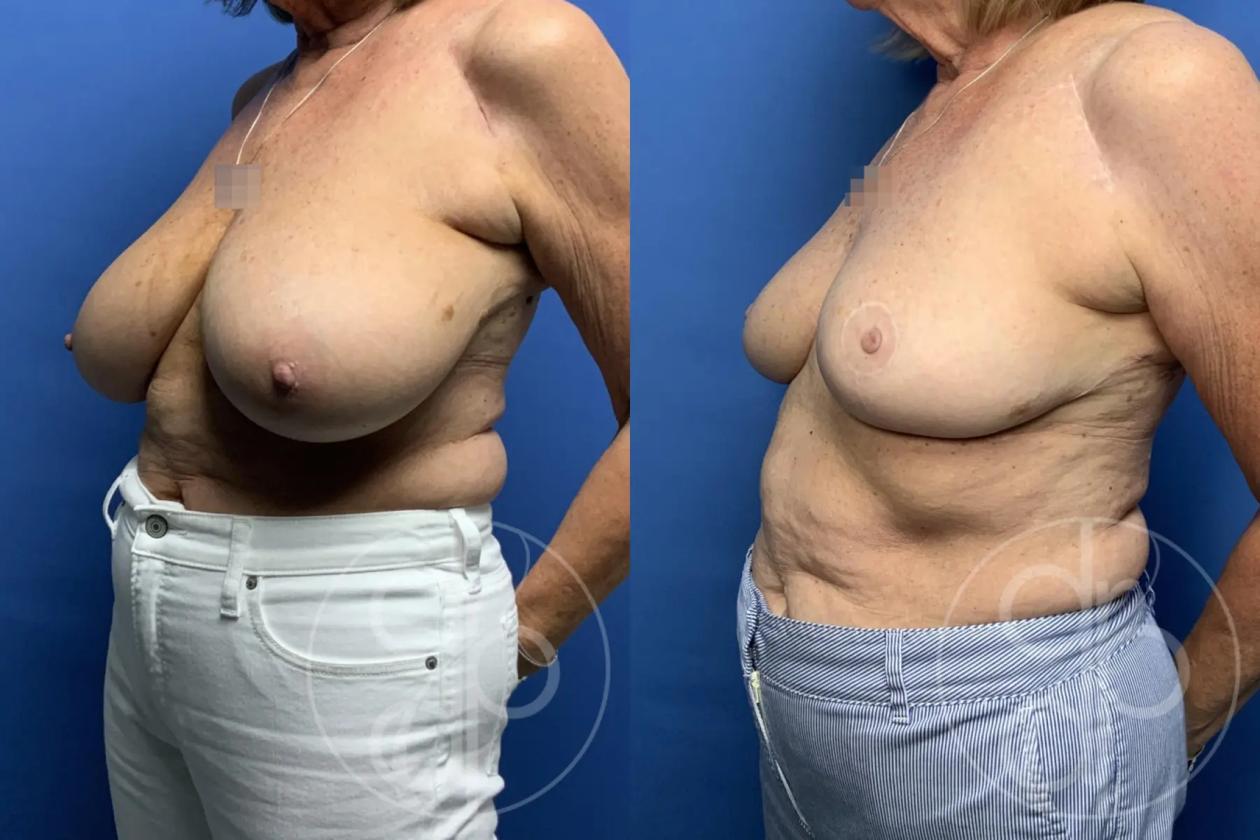 patient 13401 breast reduction before and after result - Before and After 3