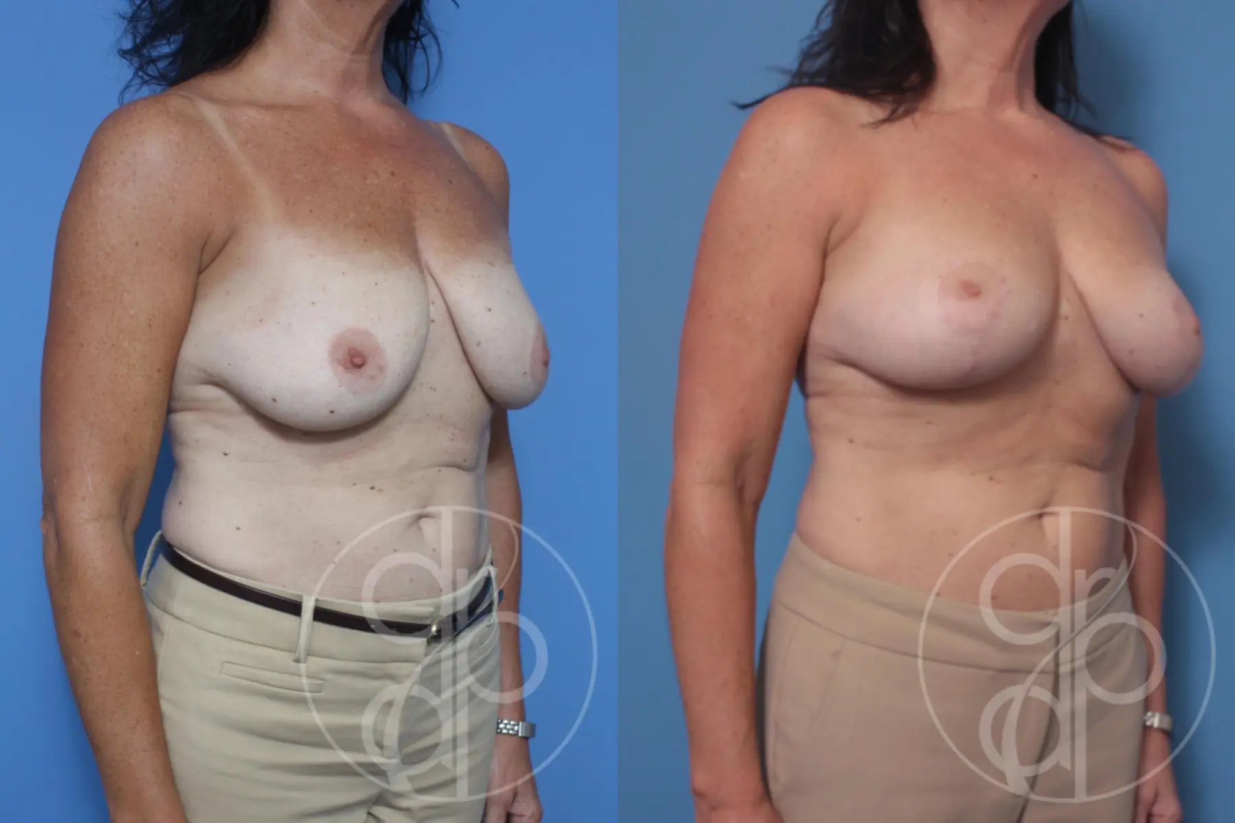 patient 10388 breast reduction before and after result - Before and After 3
