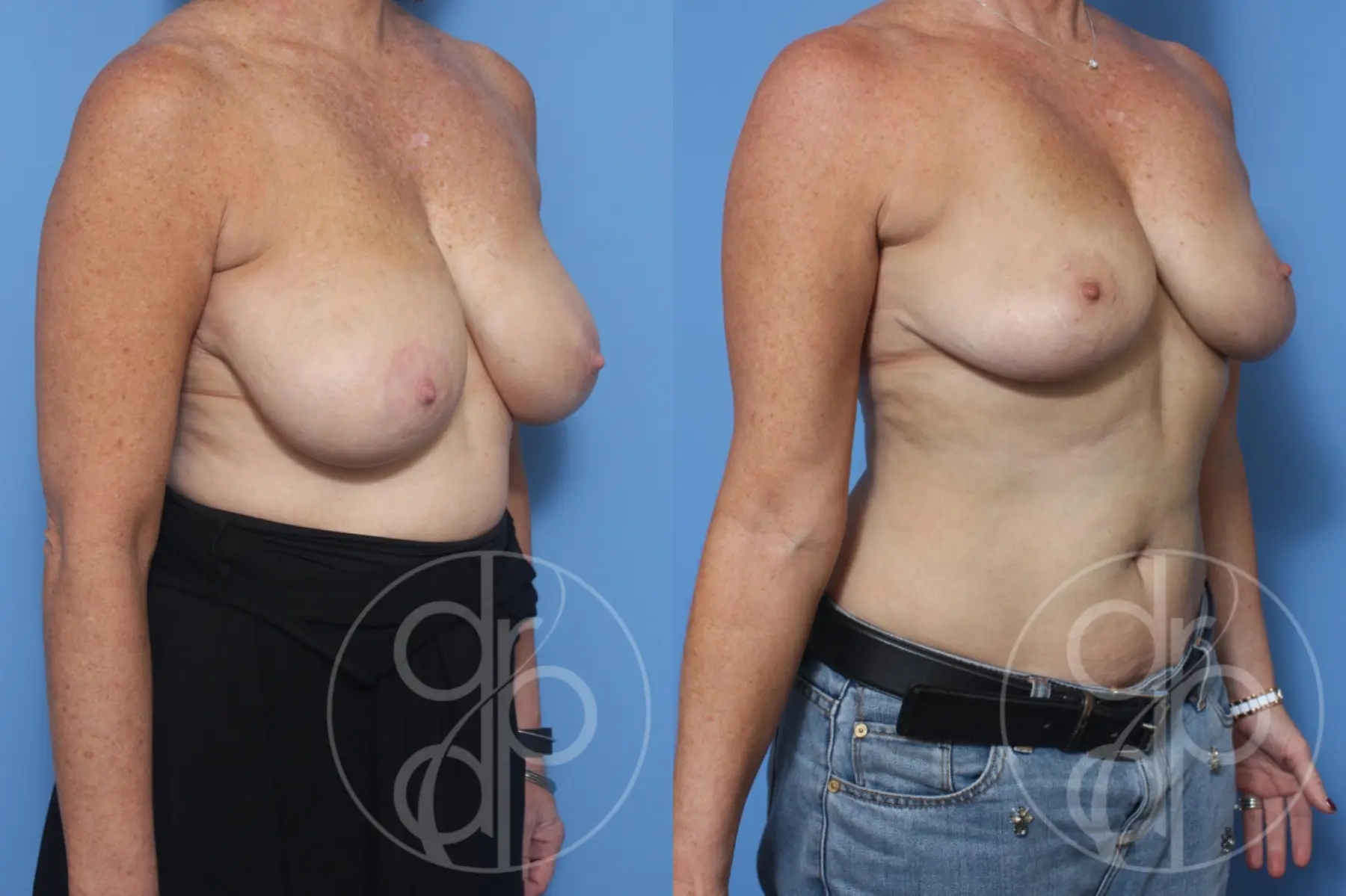 patient 13260 breast reduction before and after result - Before and After 3