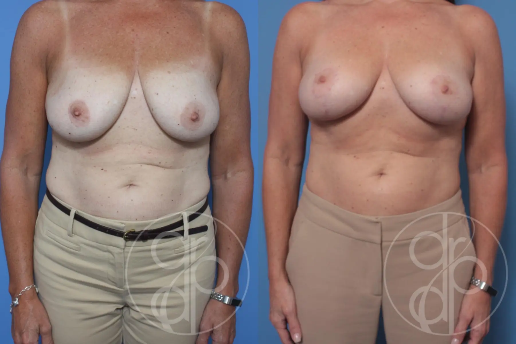 patient 10388 breast reduction before and after result - Before and After 1