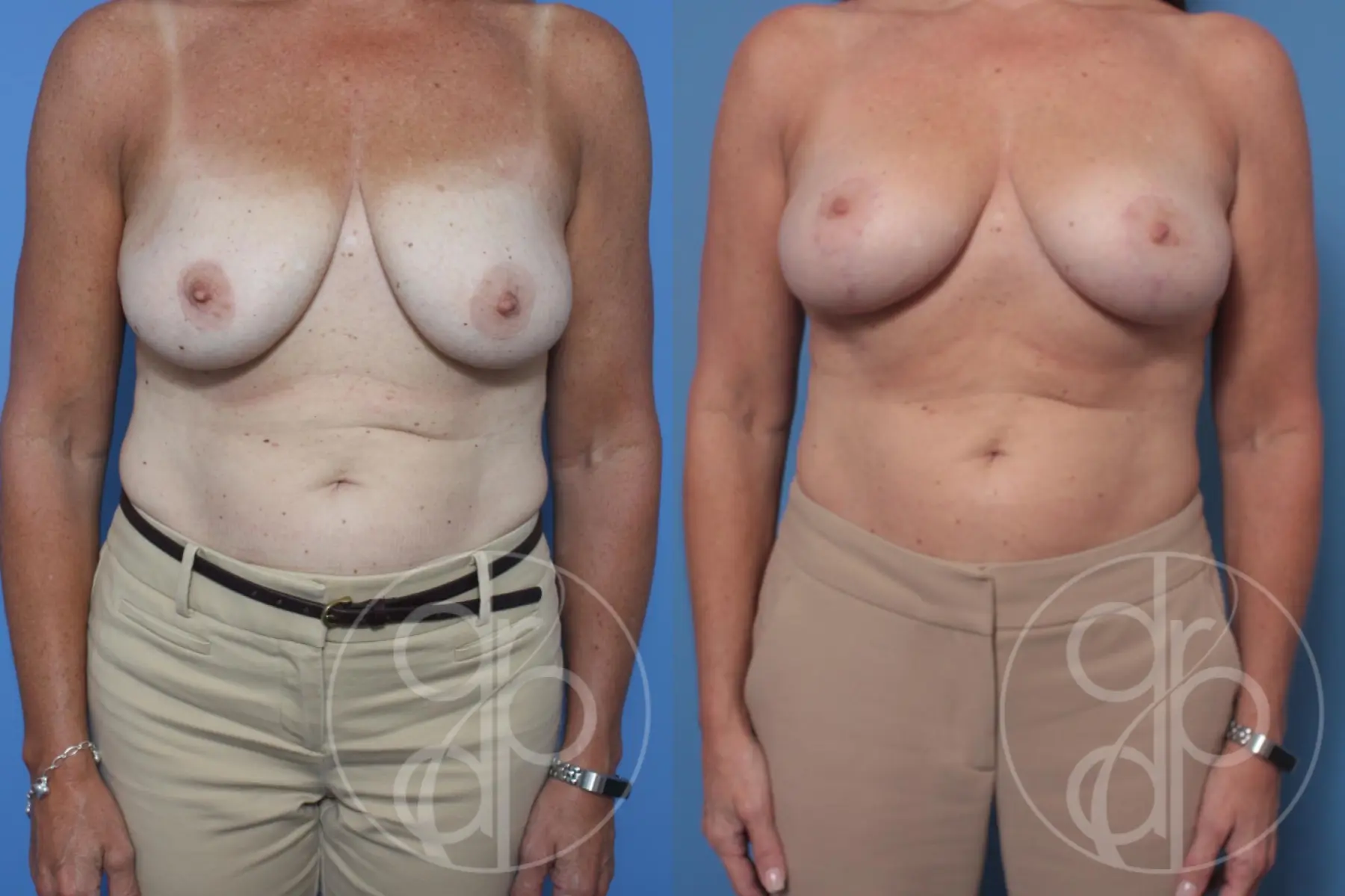 patient 10388 breast reduction before and after result - Before and After