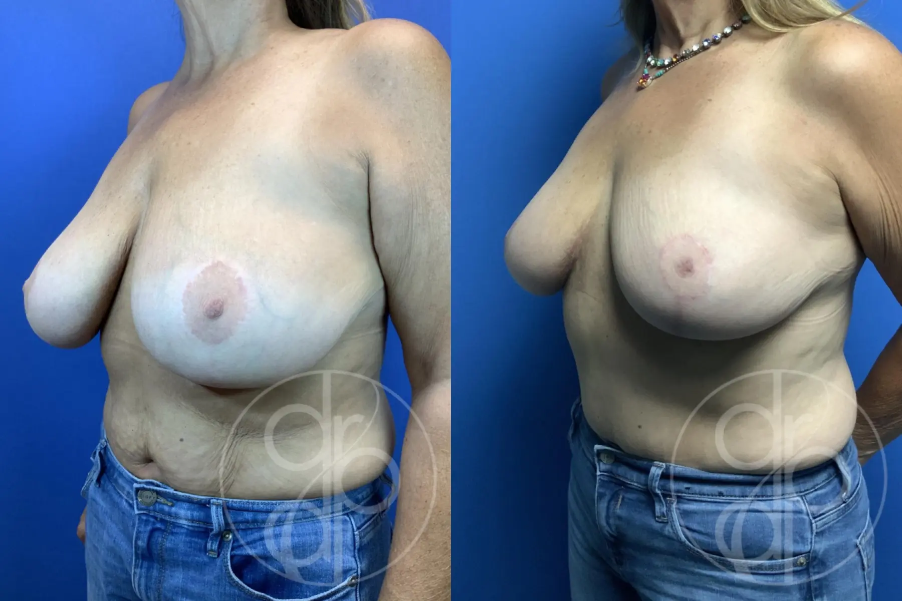 patient 11850 breast reduction before and after result - Before and After 2