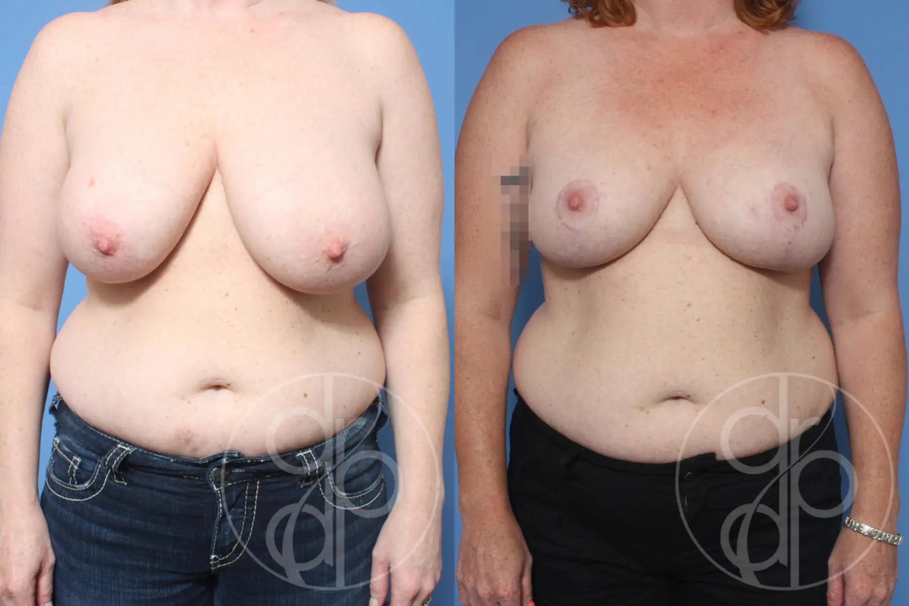 Breast Reduction: Patient 7 - Before and After 1