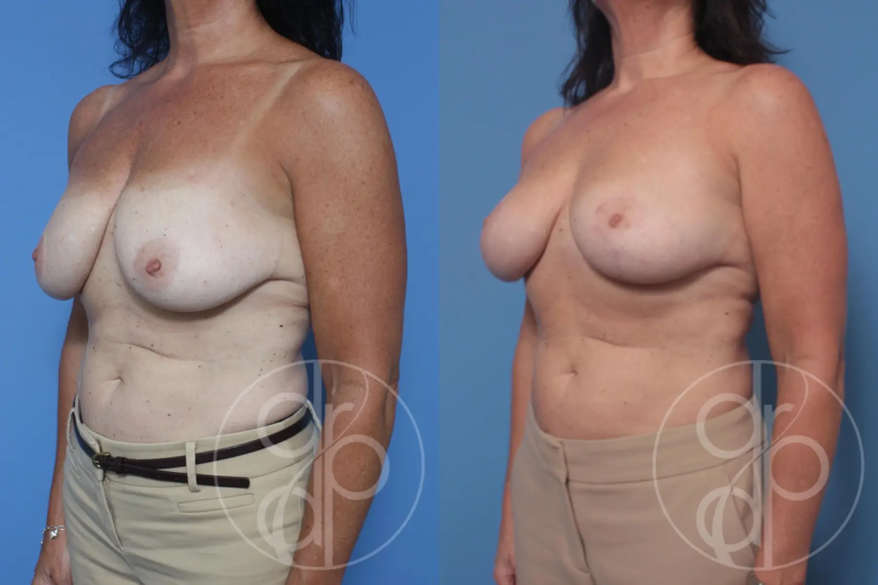 patient 10388 breast reduction before and after result - Before and After 2