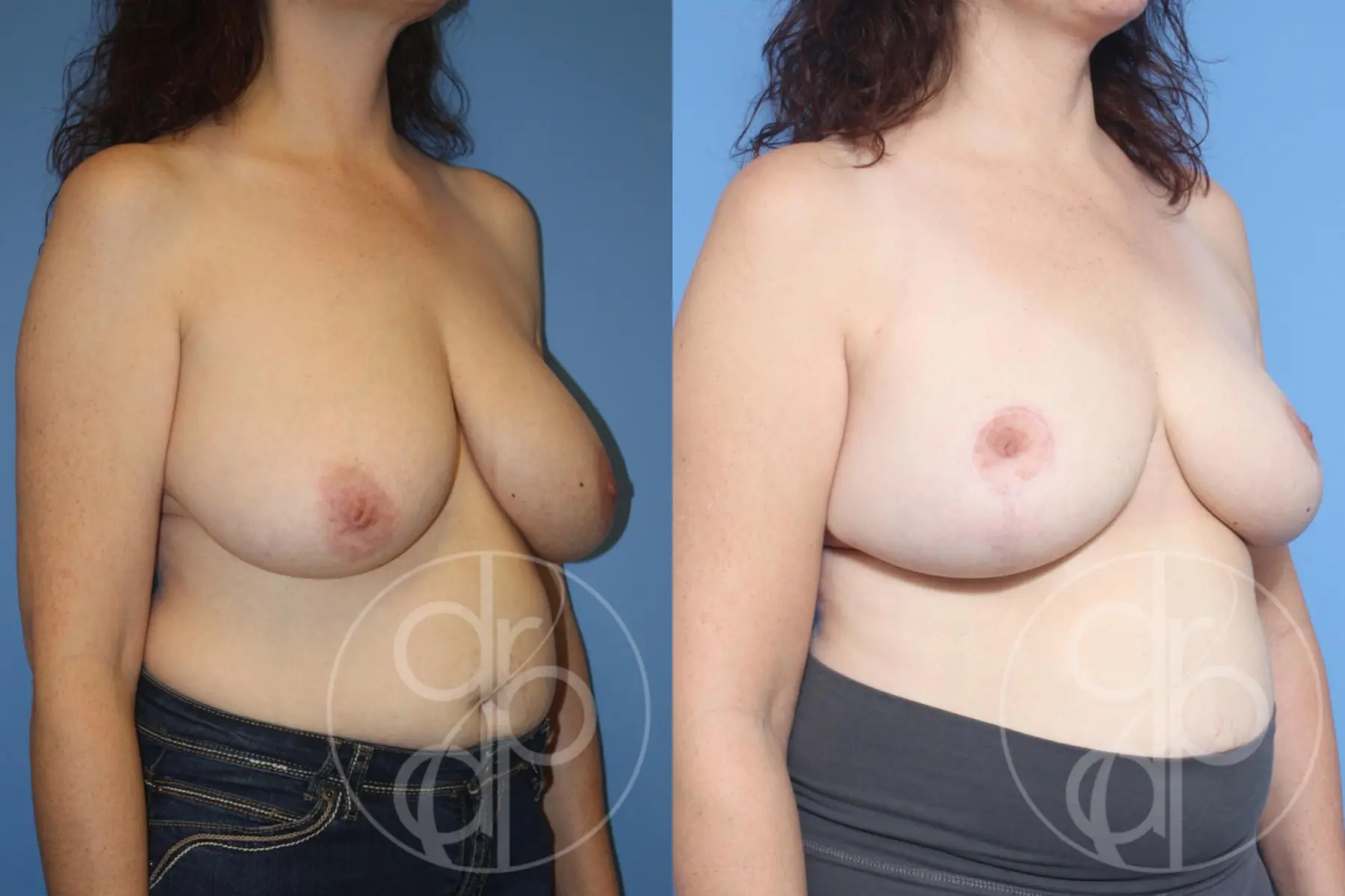 patient 12938 breast reduction before and after result - Before and After 2