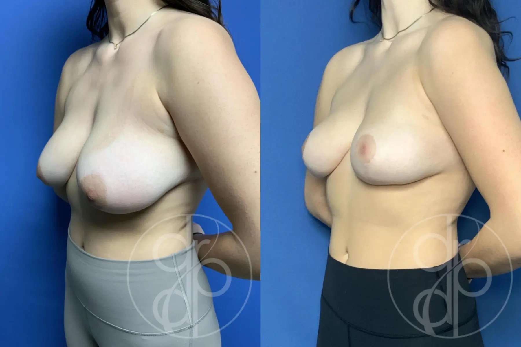Breast Reduction: Patient 27 - Before and After 4