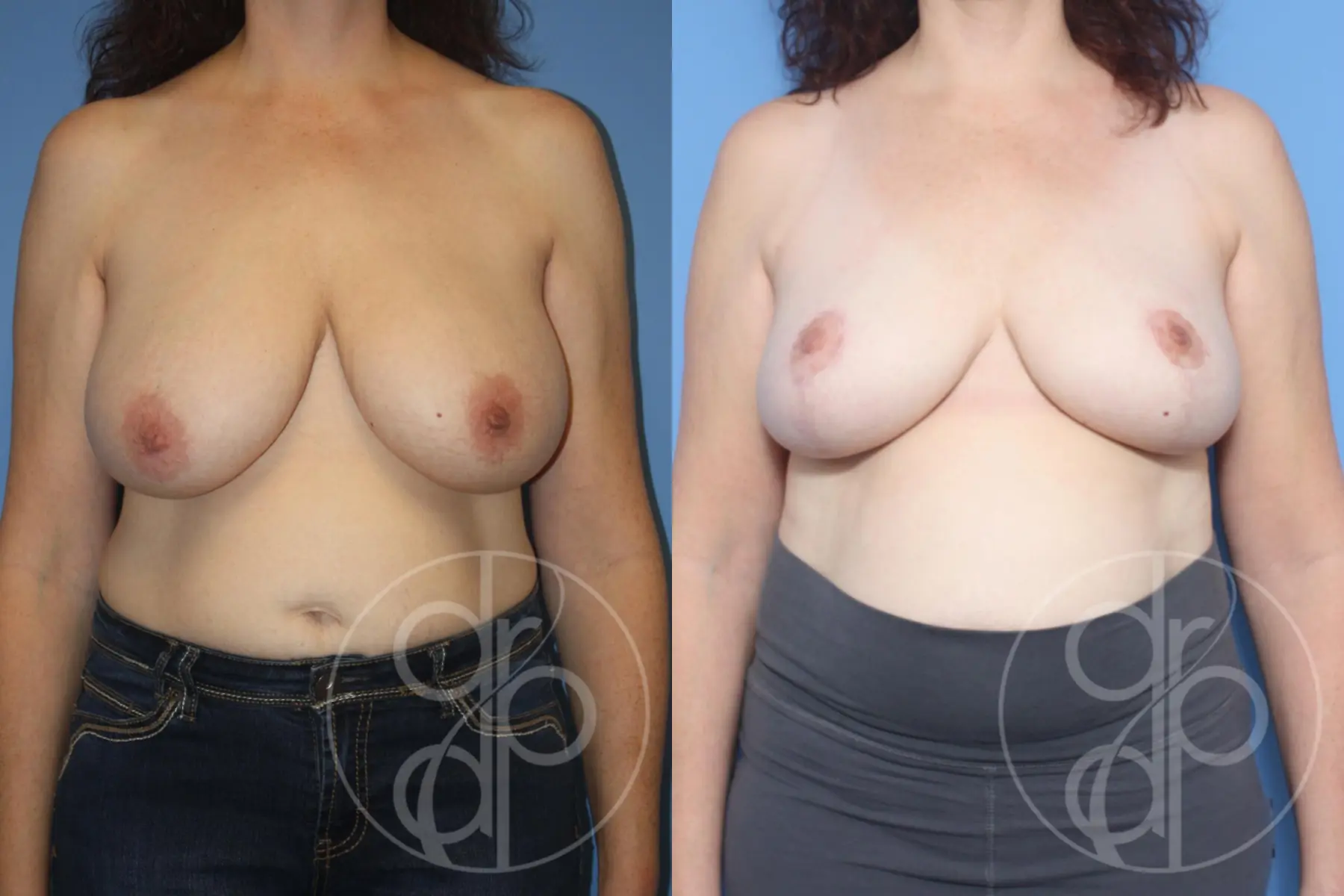 patient 12938 breast reduction before and after result - Before and After 1