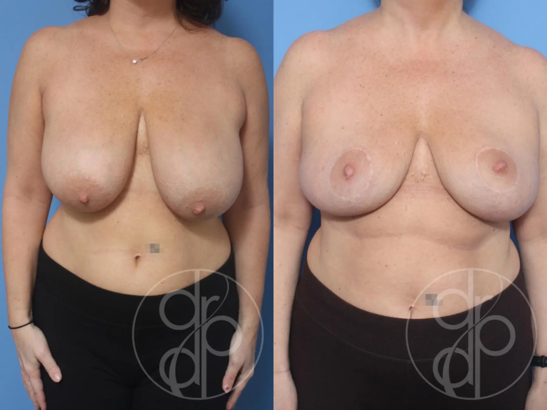 patient 12814 breast reduction before and after result - Before and After 1