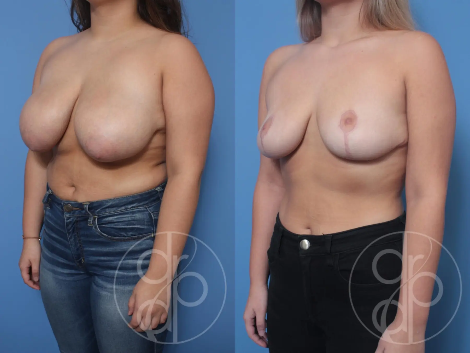 patient 10582 breast reduction before and after result - Before and After 3
