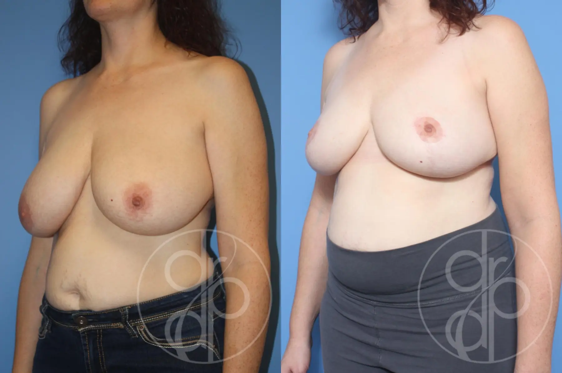patient 12938 breast reduction before and after result - Before and After 3