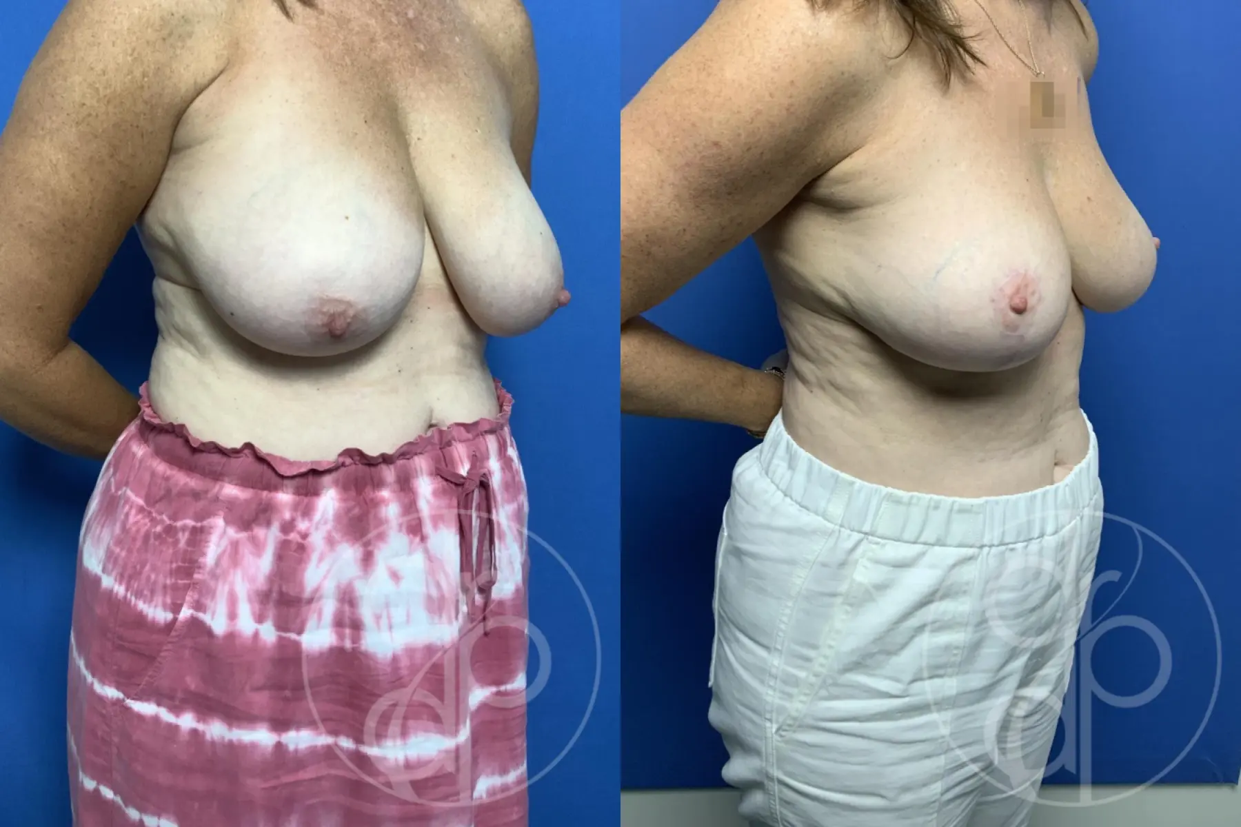 patient 10134 breast reduction before and after result - Before and After 2