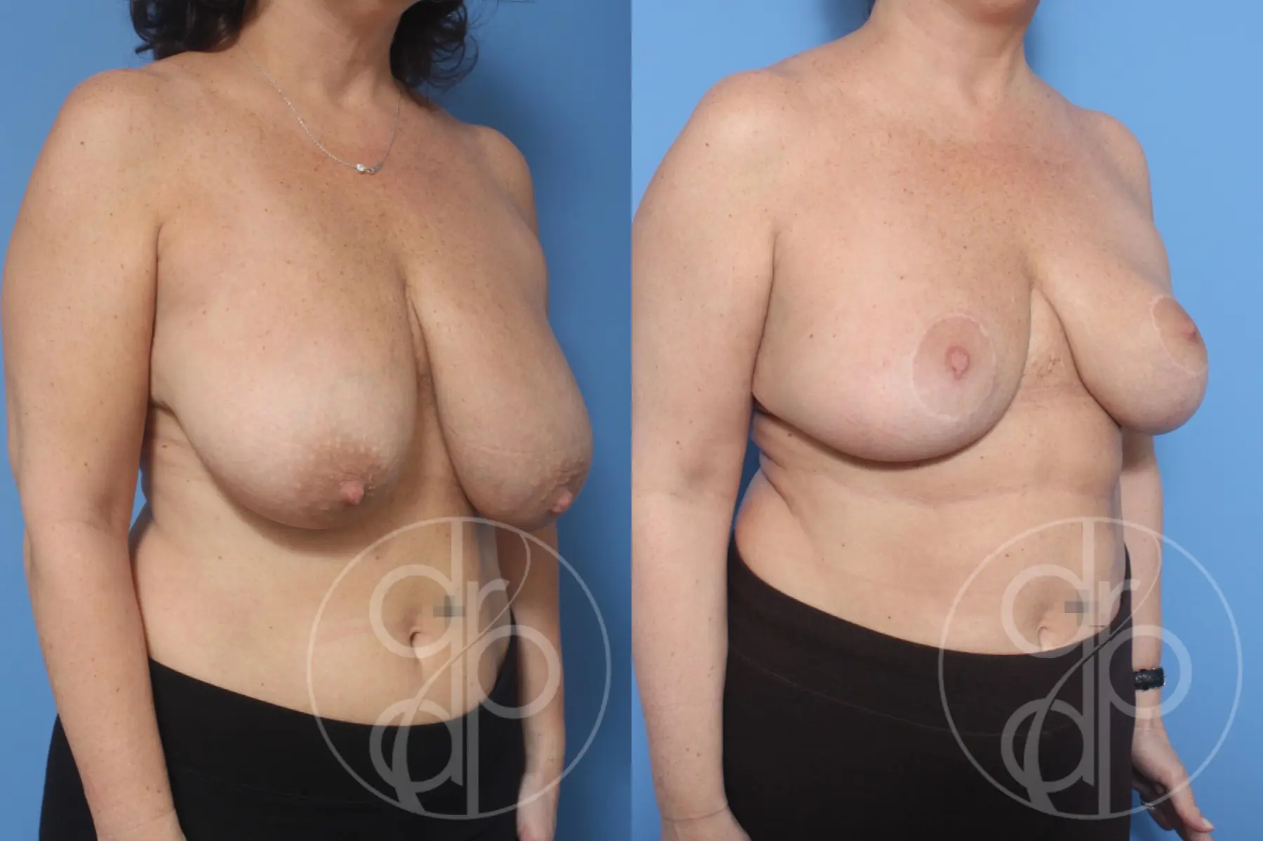 patient 12814 breast reduction before and after result - Before and After 3