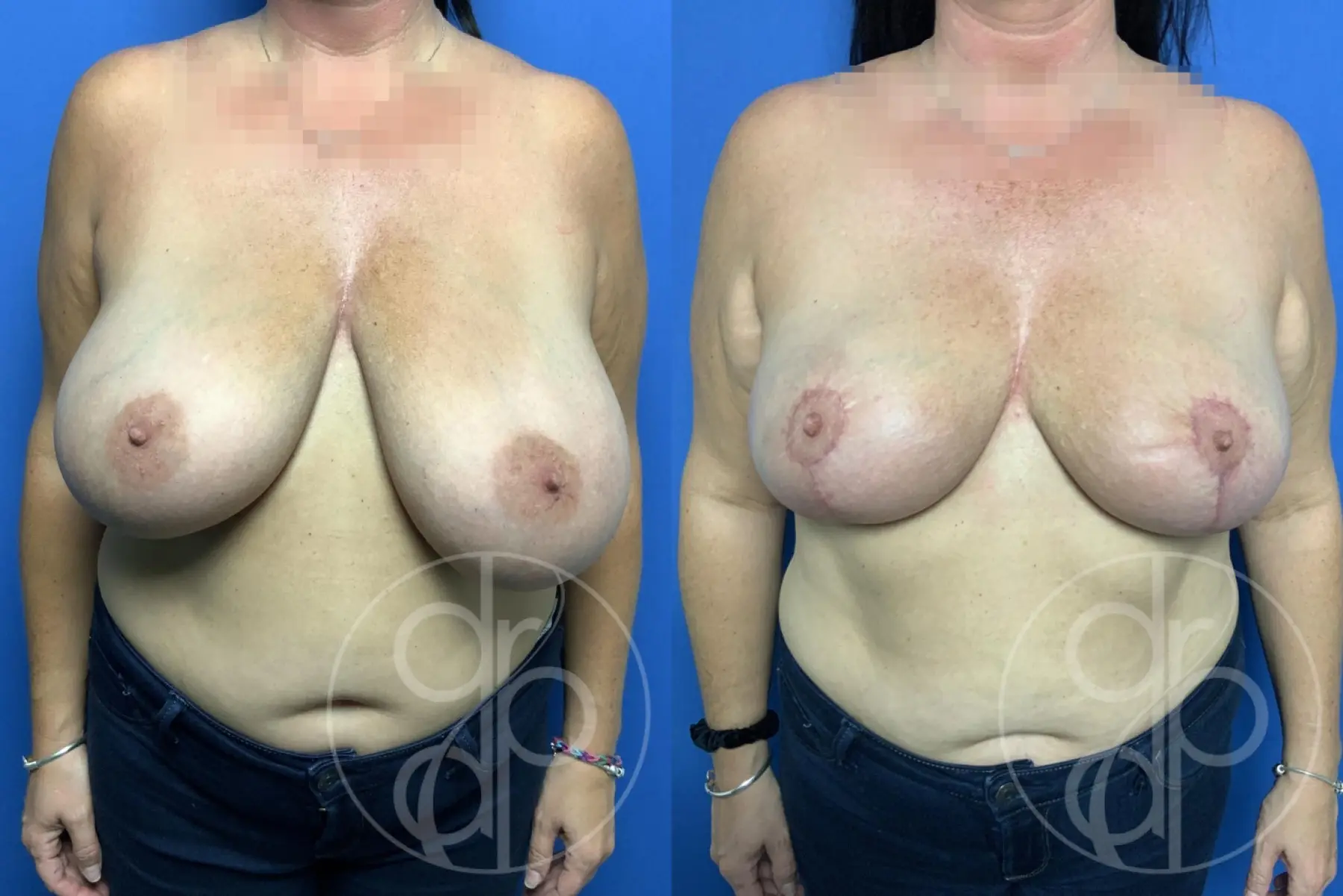patient 13362 breast reduction before and after result - Before and After